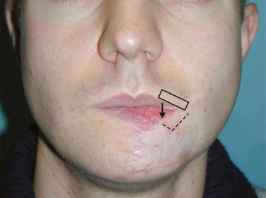 Figure 23.8, Postoperative view at 1 year, after one additional commissuroplasty. Resting position of the reconstructed lower lip.
