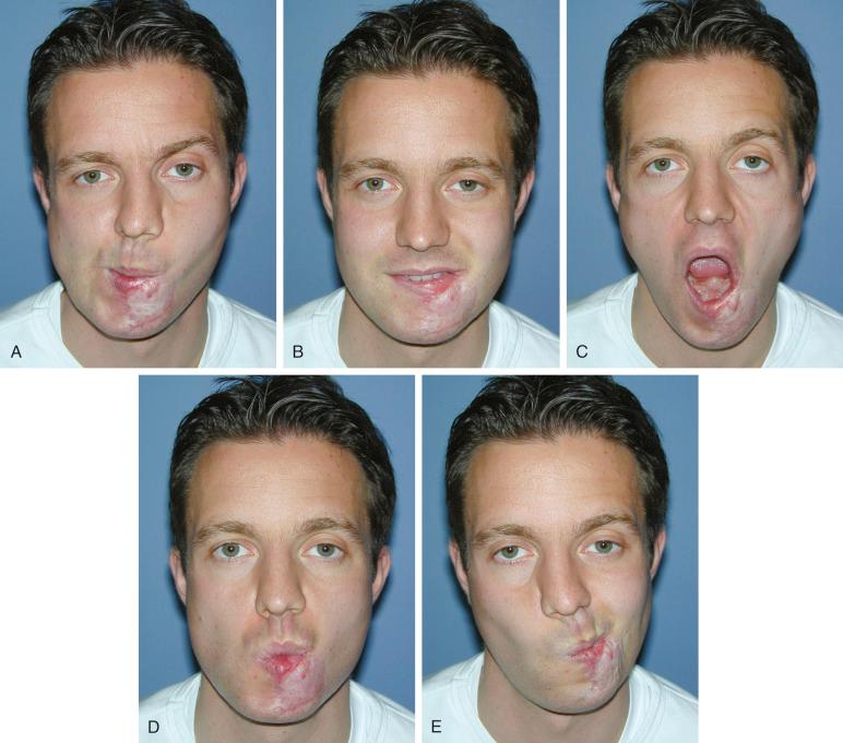 Figure 23.9, Animated movement of the lips, showing symmetric voluntary lower lip contraction.