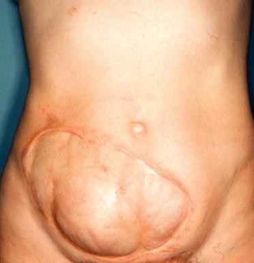 Figure 23.10, A 41-year-old patient presenting with a full-thickness abdominal wall defect measuring 25 × 14 cm and significant infraumbilical hernia, 12 years after primary tumor resection.