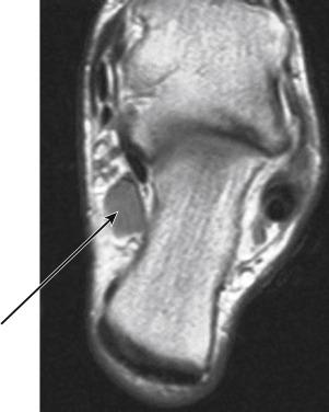 Fig.11.1, Axial T1 MRI scan of left ankle showing accessory muscle tarsal tunnel. Arrow points to accessory flexor muscle in tarsal tunnel against lateral planter nerve of posterior tibial nerve. Can be source of plantar lateral foot pain with tarsal tunnel variant involving only the lateral plantar nerve.
