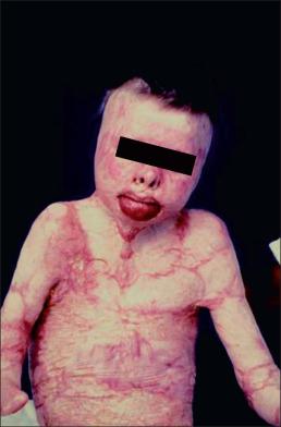 Fig. 63.1, A pediatric burn patient with a 95% total body surface area burn.