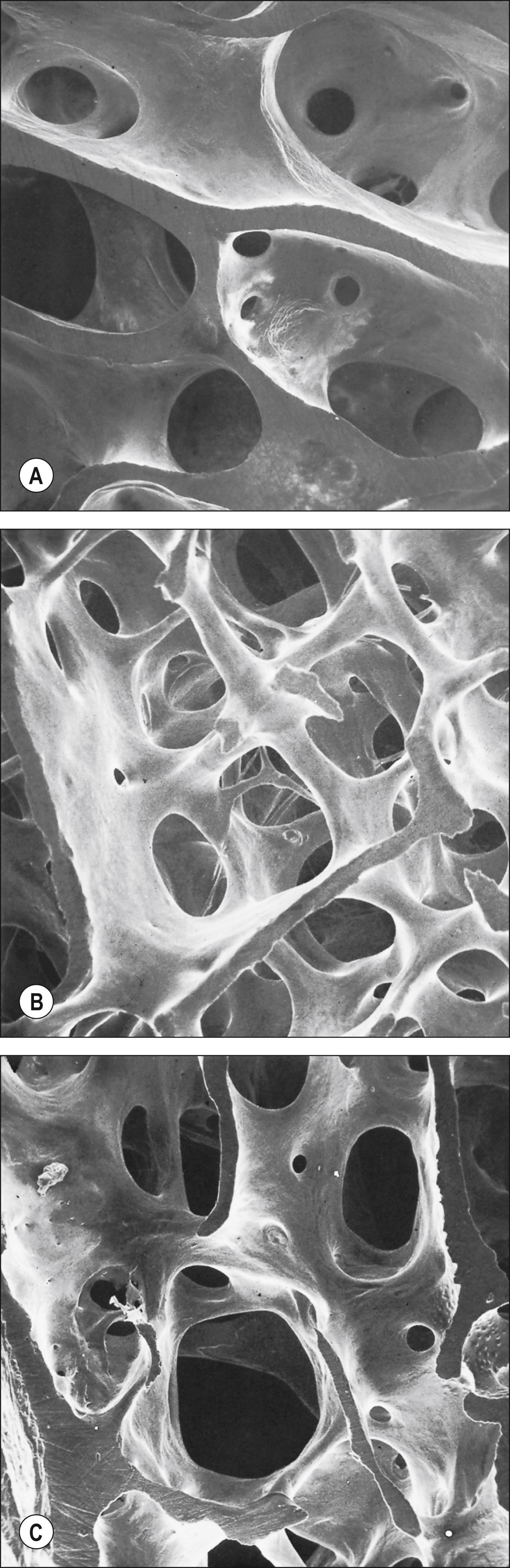 Fig. 5.9, Trabecular bone at different sites in the proximal part of the same human femur. All fields are shown at the same scale. A , Subcapital part of the neck. B , Greater trochanter. C , Rim of the articular surface of the head. Note the wide variation in thickness, orientation and spacing of the trabeculae.
