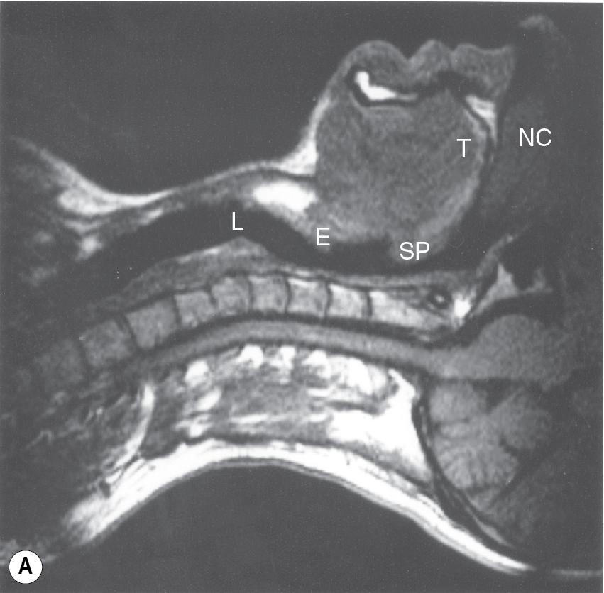 • Fig. 1.1, Magnetic resonance imaging scans showing median sagittal sections of the pharynx in a normal subject. (A) Normal nasal breathing with the oral airway occluded by lips and tongue. (B) Deliberate oral breathing with the nasal airway occluded by elevation and backwards movement of the soft palate. (C) A Valsalva manoeuvre in which the subject deliberately tries to exhale against a closed airway. Data acquisition for scans (A) and (B) took 45 s, so anatomical differences between inspiration and expiration will not be visible. I am indebted to Professor M. Bellamy for being the subject. E , Epiglottis; L, larynx; NC, nasal cavity; SP, soft palate; T, tongue; VF, vocal fold.