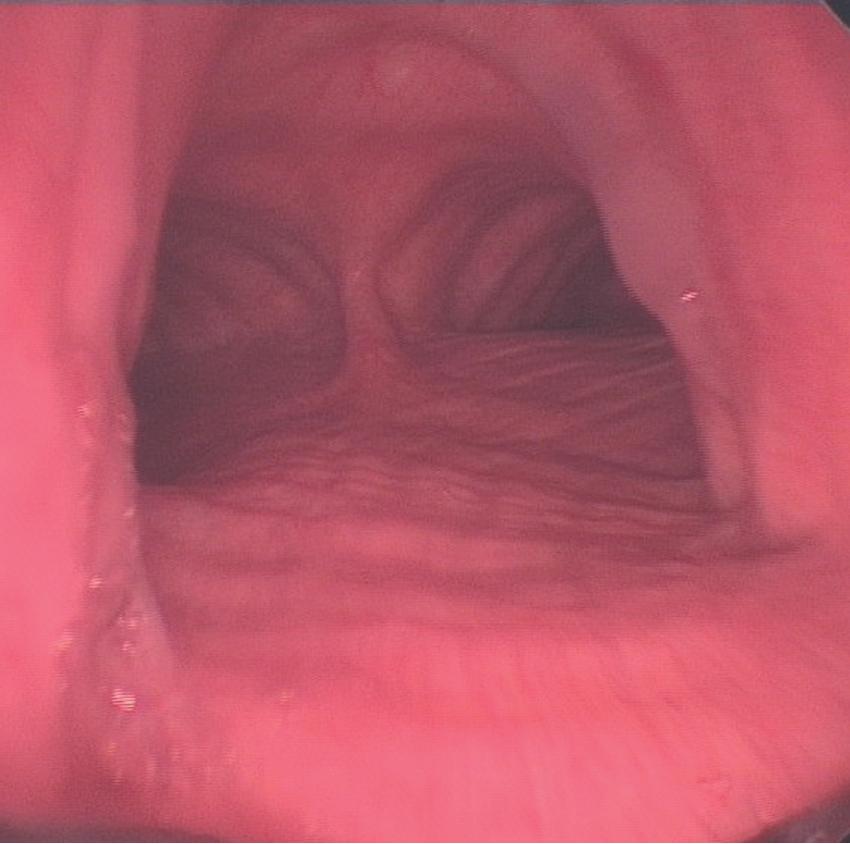 • Fig. 1.3, The normal trachea as viewed during a rigid bronchoscopy (page 399). The ridges of the cartilage rings are seen anteriorly, and the longitudinal fibres of the trachealis muscle are seen posteriorly, dividing at the carina and continuing down both right and left main bronchi. The less acute angle of the right main bronchus from the trachea can be seen, with its lumen clearly visible, illustrating why inhaled objects preferentially enter the right lung.