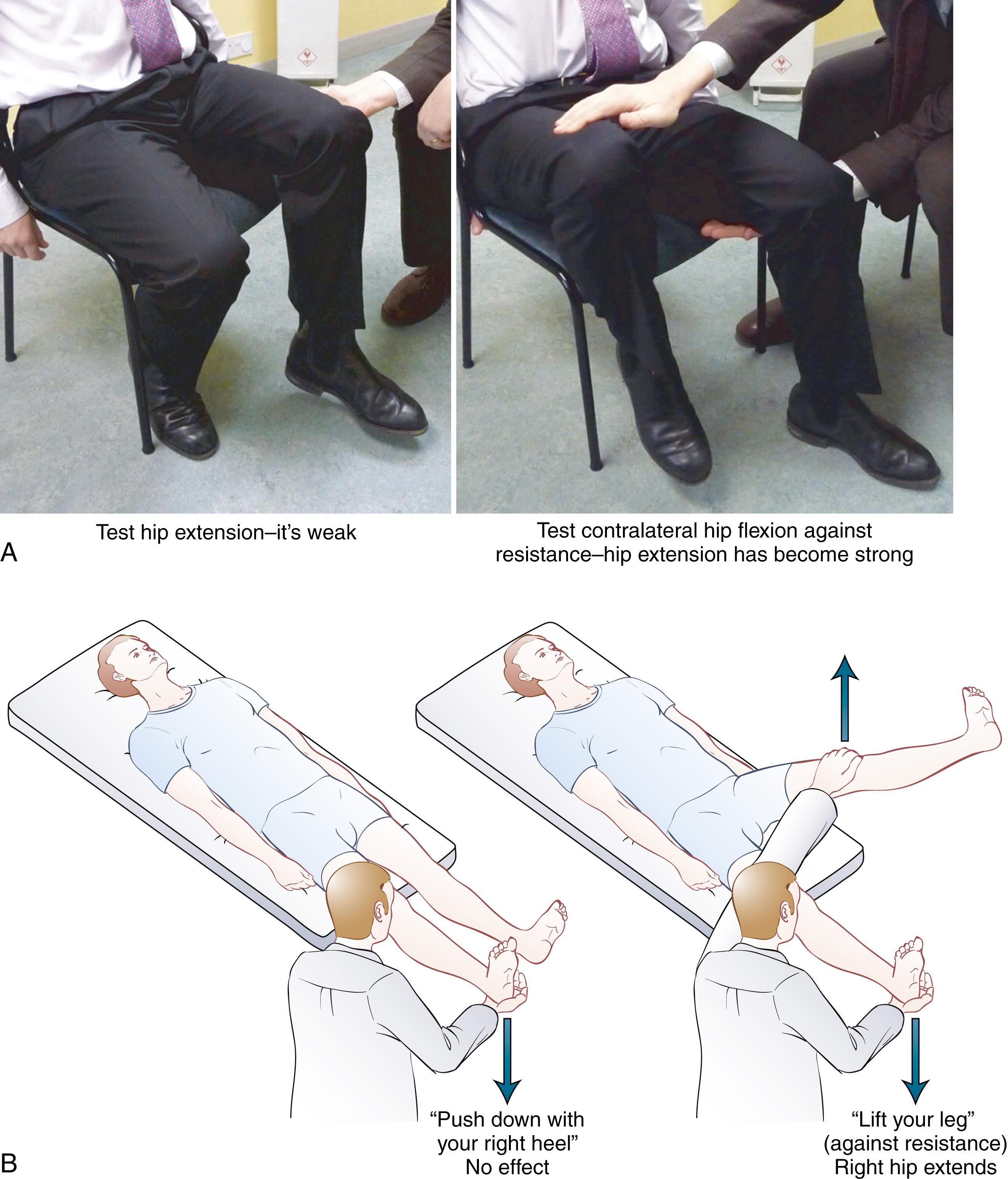 Fig. 113.2, Hoover Sign Demonstration. A. In the seated position and B. in the supine position