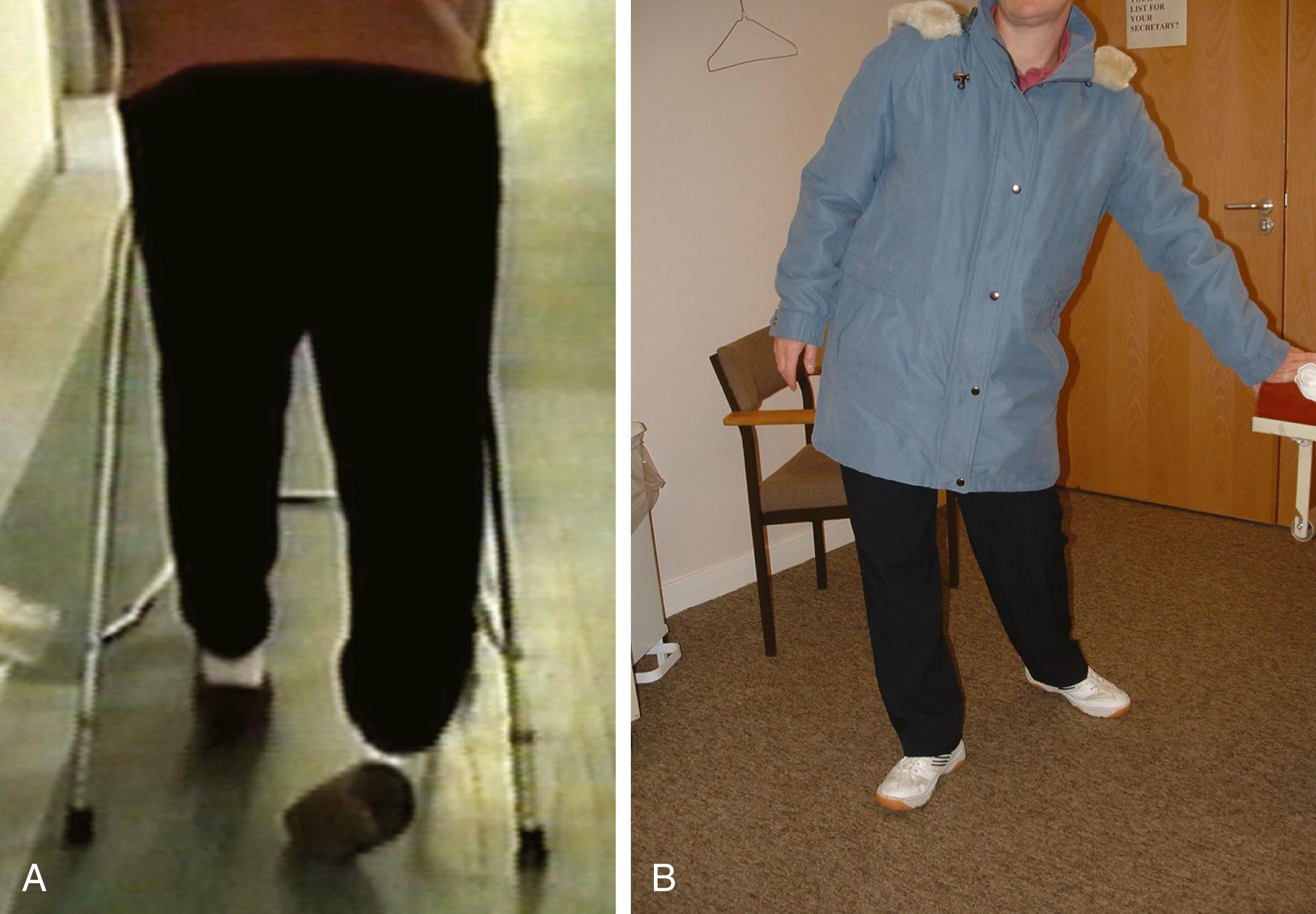 Fig. 113.3, A dragging gait with external (B) or internal (A) hip rotation is characteristic of functional leg weakness.