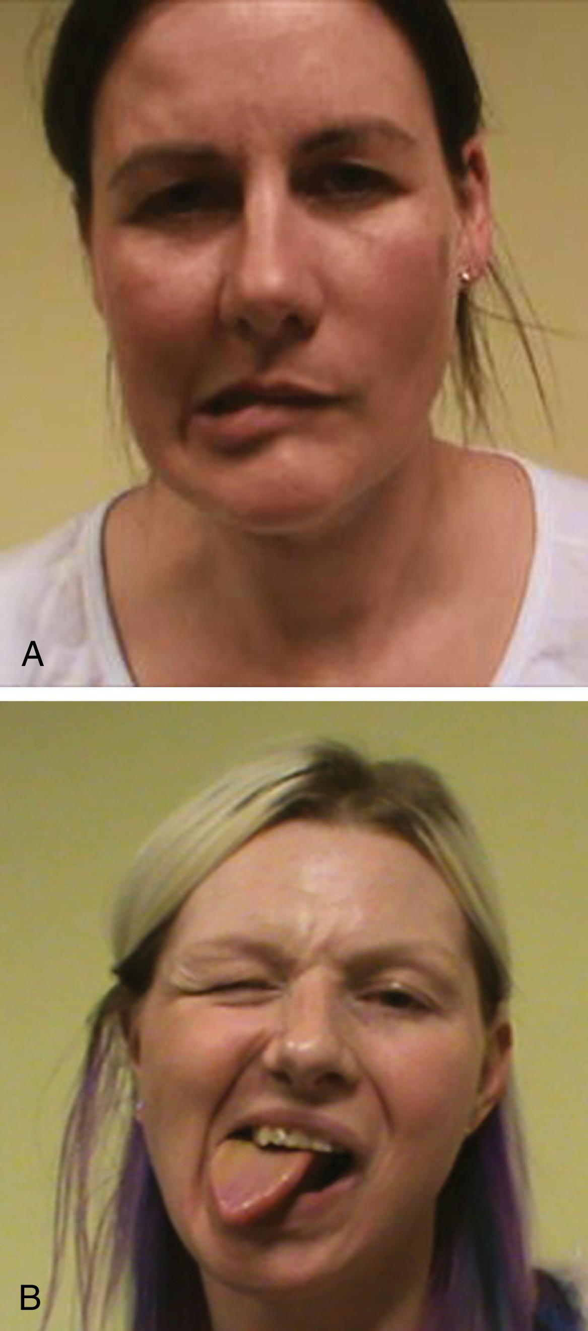 Fig. 113.4, Functional facial spasm, leading to ( A ) deviation of the chin and downward movement of the corner of the mouth from platysma contraction and ( B ) upward contraction of the mouth and orbicularis.