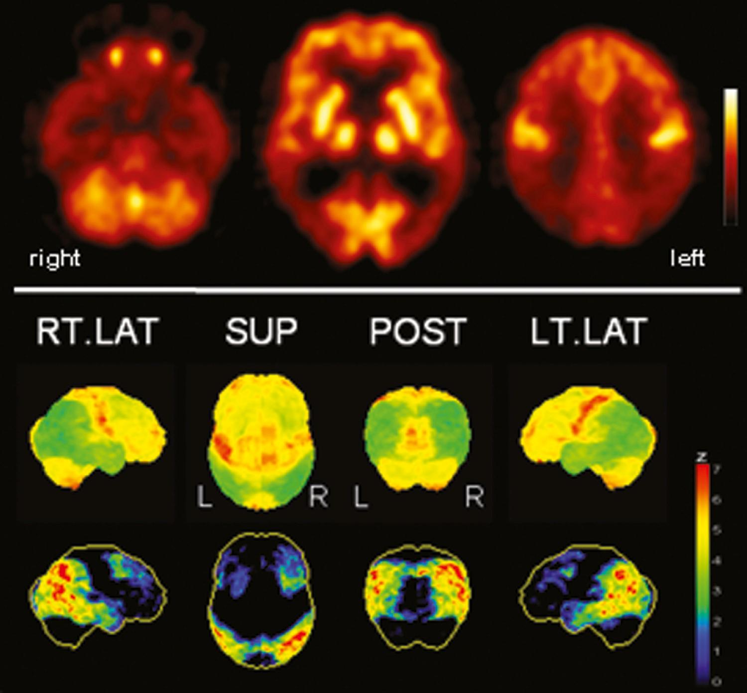 Fig. 42.2, [ 18 F]FDG positron emission tomography (PET) in advanced Alzheimer disease. Advanced disease stage is characterized by severe hypometabolism of temporal and parietal cortices and posterior cingulate gyrus and precuneus. Frontal cortex is also involved, while sensorimotor and occipital cortices, basal ganglia, thalamus, and cerebellum are spared. Mesiotemporal hypometabolism is also apparent. Upper panel , Transaxial PET images of [ 18 F]FDG uptake. Lower panel , Results of voxel-based statistical analysis using Neurostat/3D-SSP. Given are right and left lateral ( RT.LAT and LT.LAT ), superior ( SUP ), and posterior ( POST ) views (see Fig. 42.1 for additional details).