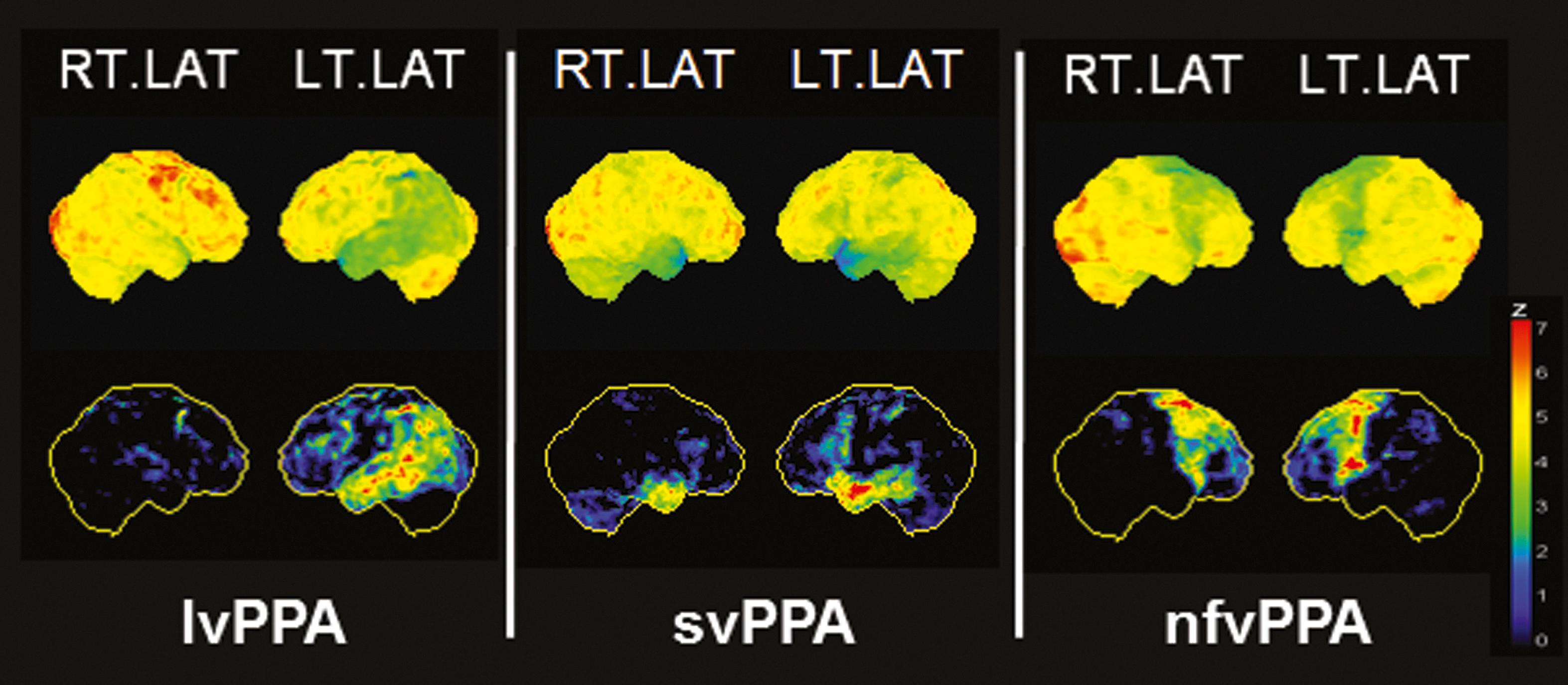 Fig. 42.3, [ 18 F]FDG positron emission tomography (PET) in the different variants of primary progressive aphasia (PPA). [ 18 F]FDG PET scans in logopenic variant PPA (lvPPA) are characterized by a leftward asymmetric temporoparietal hypometabolism, whereas the semantic variant PPA (svPPA) involves the most rostral part of the temporal lobes. Patients with the nonfluent variant PPA (nfvPPA) typically show leftward asymmetric frontal hypometabolism with inferior frontal or posterior frontoinsular emphasis. Results of voxel-based statistical analysis using Neurostat/3D-SSP. Given are right and left lateral ( RT.LAT and LT.LAT ) views (see Fig. 42.1 for additional details).