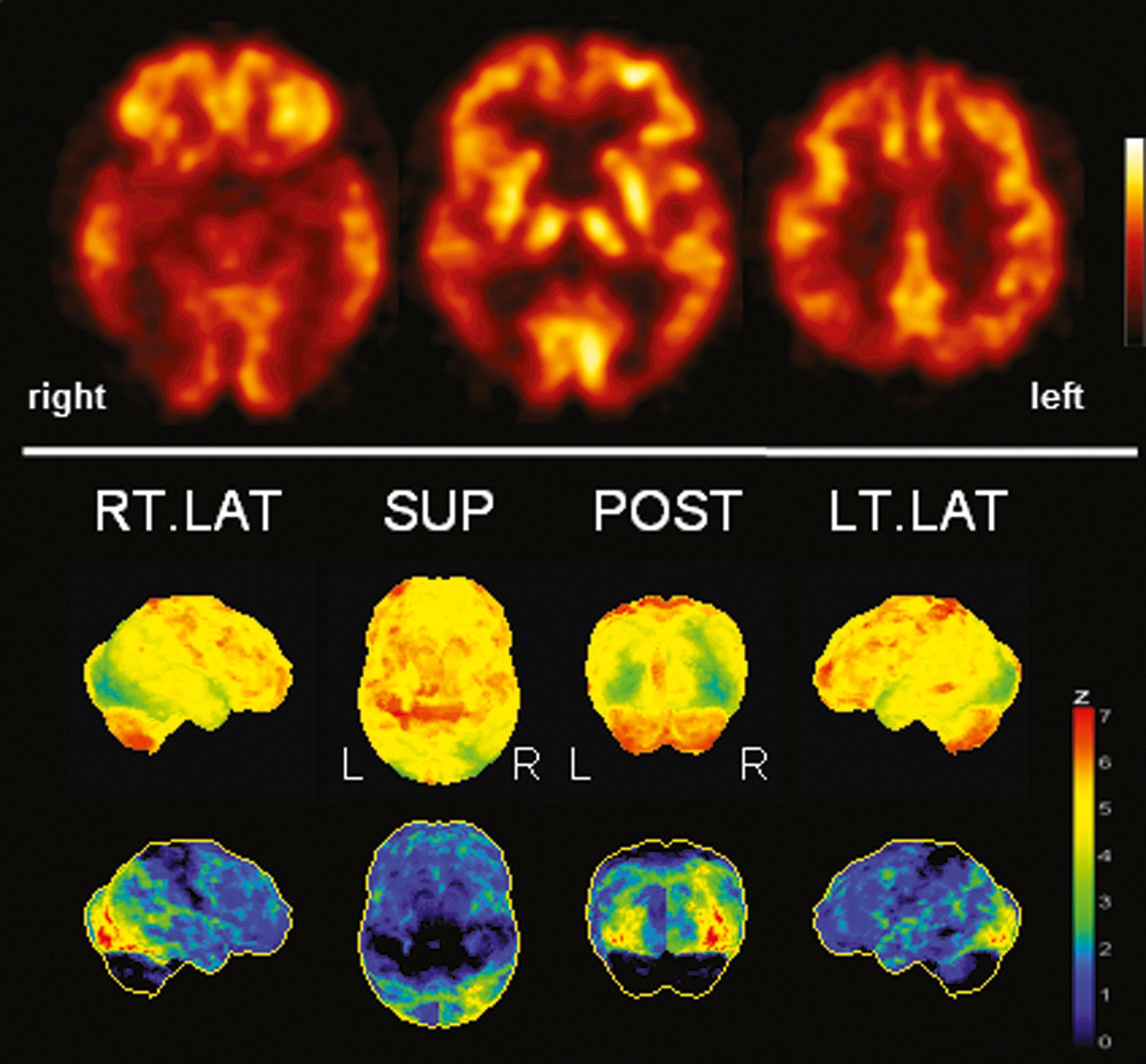 Fig. 42.4, [ 18 F]FDG positron emission tomography (PET) in posterior cortical atrophy (PCA). Patients with PCA usually show a rightward asymmetric temporoparietal hypometabolism with strong involvement of the lateral occipital cortex. Results of voxel-based statistical analysis using Neurostat/3D-SSP. Given are right and left lateral ( RT.LAT and LT.LAT ), superior ( SUP ), and posterior ( POST ) views (see Fig. 42.1 for additional details).