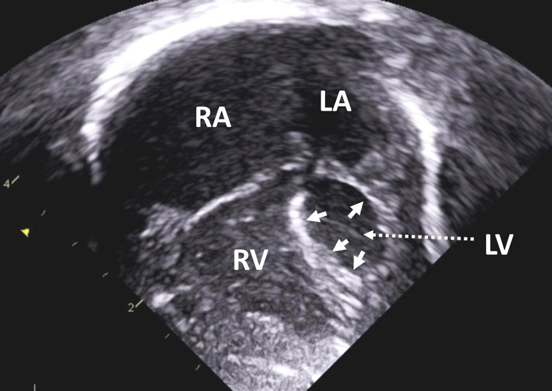 Figure 1, Apical four-chamber view in a neonate with hypoplastic left heart syndrome and severe mitral and aortic stenosis. The left ventricle is diminutive, nonapex forming, and dysfunctional. Note the presence of endocardial fibroelastosis ( arrows ). LA , left atrium; LV , left ventricle; RA , right atrium; RV , right ventricle.