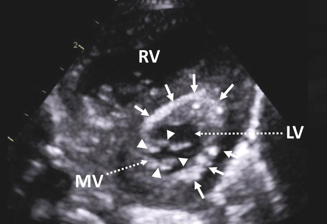 Figure 2, Parasternal short-axis view in a patient with hypoplastic left heart syndrome demonstrating a severely reduced mitral valve orifice area ( arrowheads ) and endocardial fibroelastosis ( arrows ). LV , left ventricle; MV , mitral valve; RV , right ventricle.
