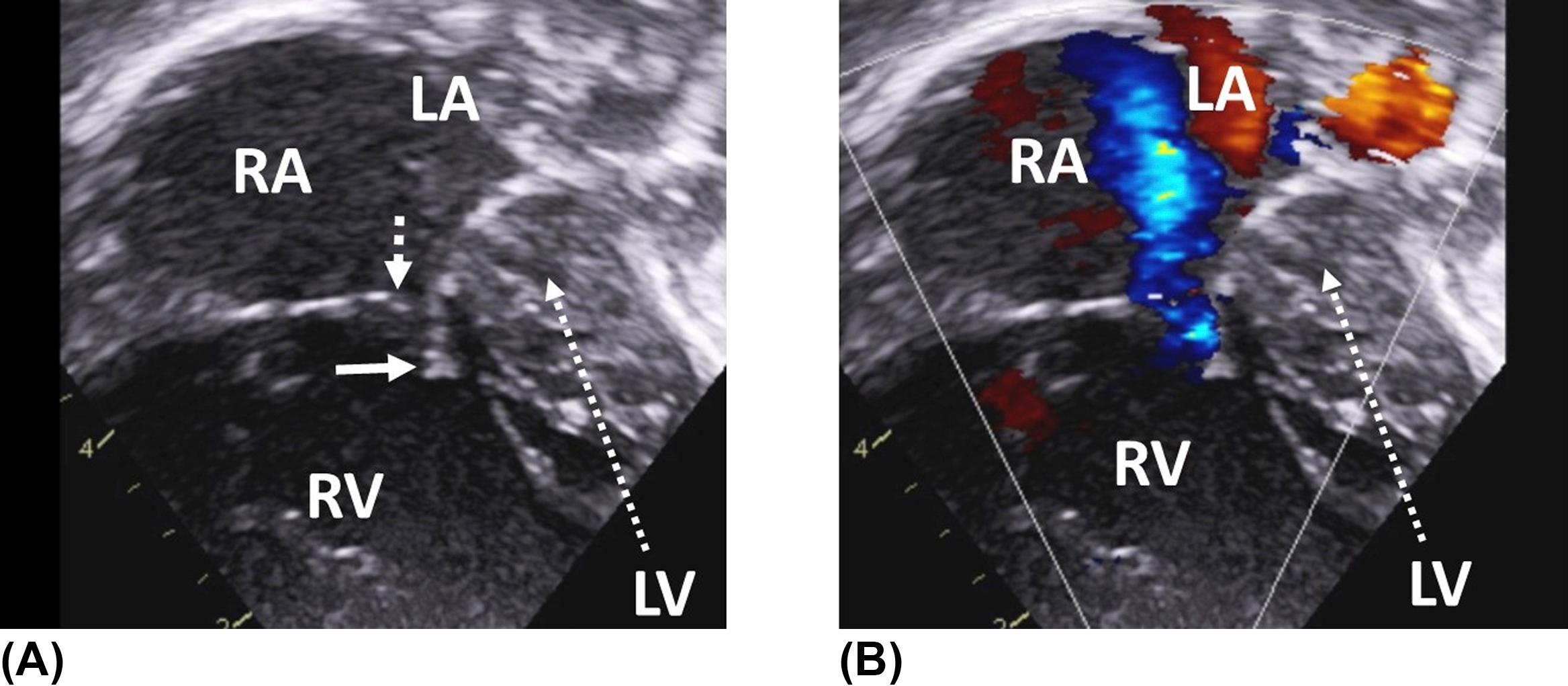 Figure 4, (A) Apical four-chamber view in a newborn with hypoplastic left heart syndrome and a very diminutive left ventricle. Note the incomplete coaptation between the anterior and septal leaflets of the tricuspid valve caused by the reduced motion of the fixed septal leaflet. Dotted arrow indicates the tip of the antero-superior tricuspid valve leaflet, plain arrow the tip of the septal tricuspid valve leaflet. (B) As a consequence, there is severe tricuspid regurgitation contributing to the dilatation of the right-sided chambers. LA , left atrium; LV , left ventricle; RA , right atrium; RV , right ventricle.