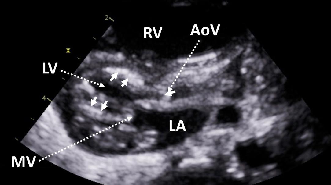 Figure 6, Parasternal long-axis view demonstrating hypoplasia of the left ventricle. The aortic and mitral valves are small and severely stenotic. There is hyperechogenicity of the endocardium consistent with endocardial fibroelastosis ( arrows ). AoV , aortic valve; LA , left atrium; LV , left ventricle; MV , mitral valve; RV , right ventricle.