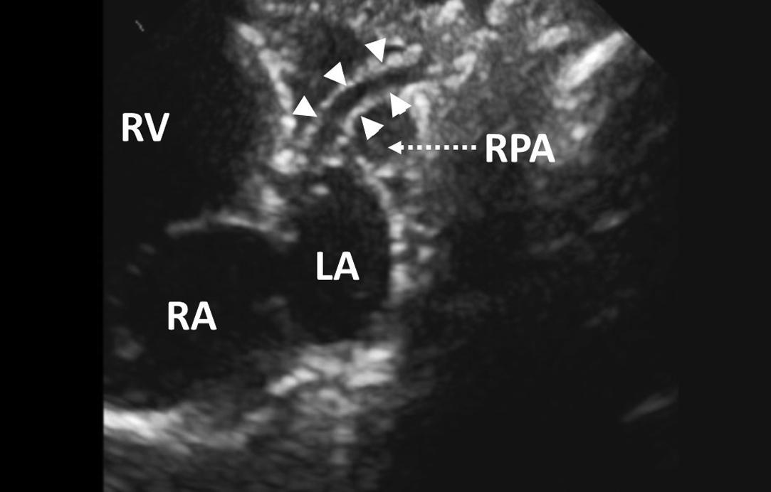 Figure 7, Modified suprasternal notch view in a neonate with hypoplastic left heart syndrome and mitral and aortic atresia. Arrowheads indicate the very hypoplastic ascending aorta, the size of which is much smaller than the diameter of the right pulmonary artery. LA , left atrium; RA , right atrium; RPA , right pulmonary artery; RV , right ventricle.