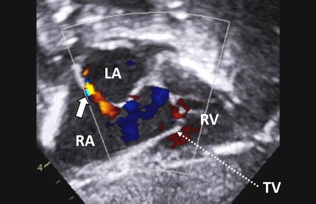 Figure 10, Patients with hypoplastic left heart syndrome are usually born with a restrictive interatrial communication, as illustrated in this figure. It is thought that intrauterine restriction at the atrial level decreases blood flow to the left side of the heart, thus contributes to its underdevelopment. Subcostal view with color flow mapping showing restrictive left-to-right shunt across a small patent foramen ovale ( arrow ). LA , left atrium; RA , right atrium; RV , right ventricle; TV , tricuspid valve.