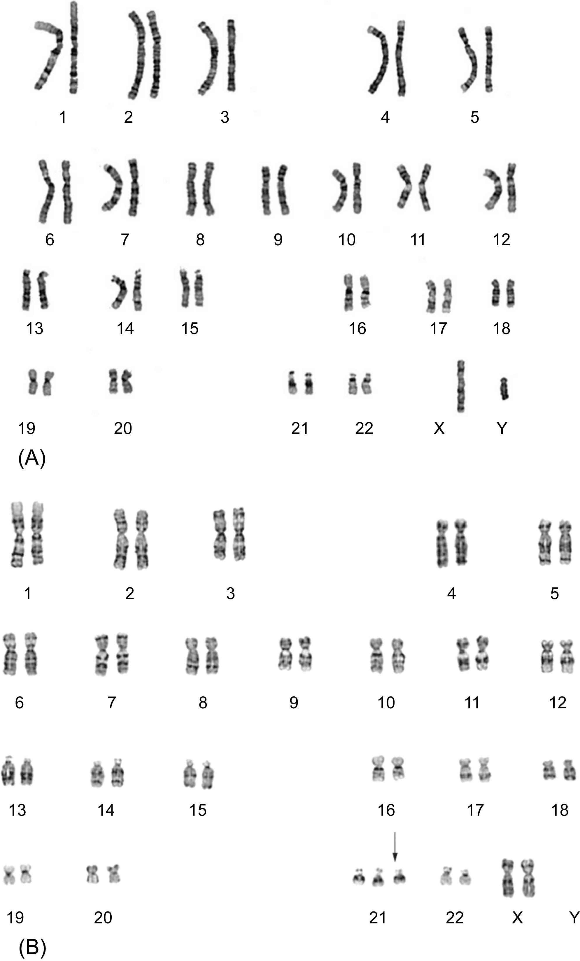 Figure 4.1, (A) A normal human male karyotype using G-banding technique. (B) A trisomy 21 karyotype.