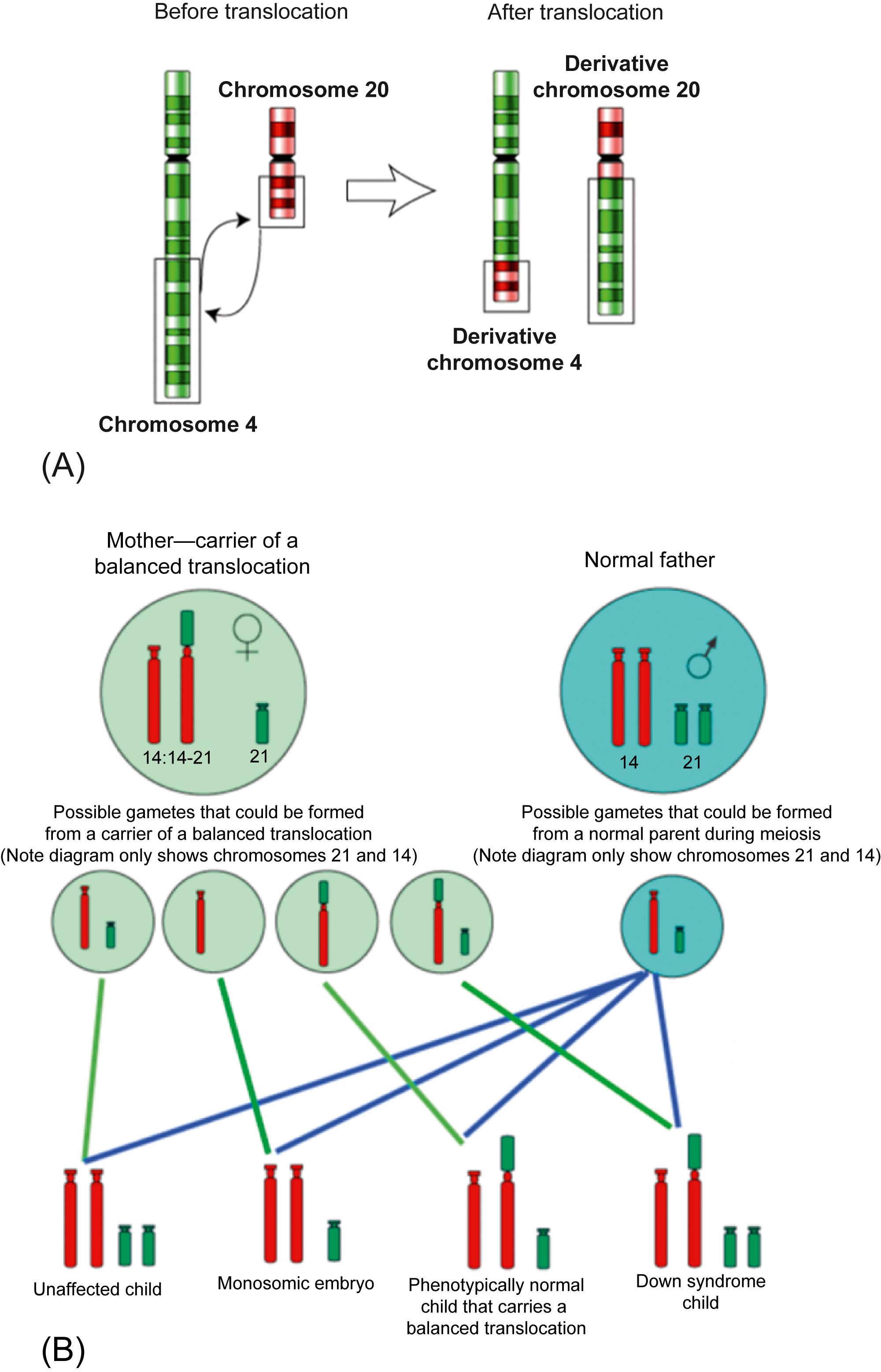 Figure 4.2, (A) Representation of a balanced translocation between chromosomes 4 and 20. (B) A schematic of how unbalanced translocations are inherited.