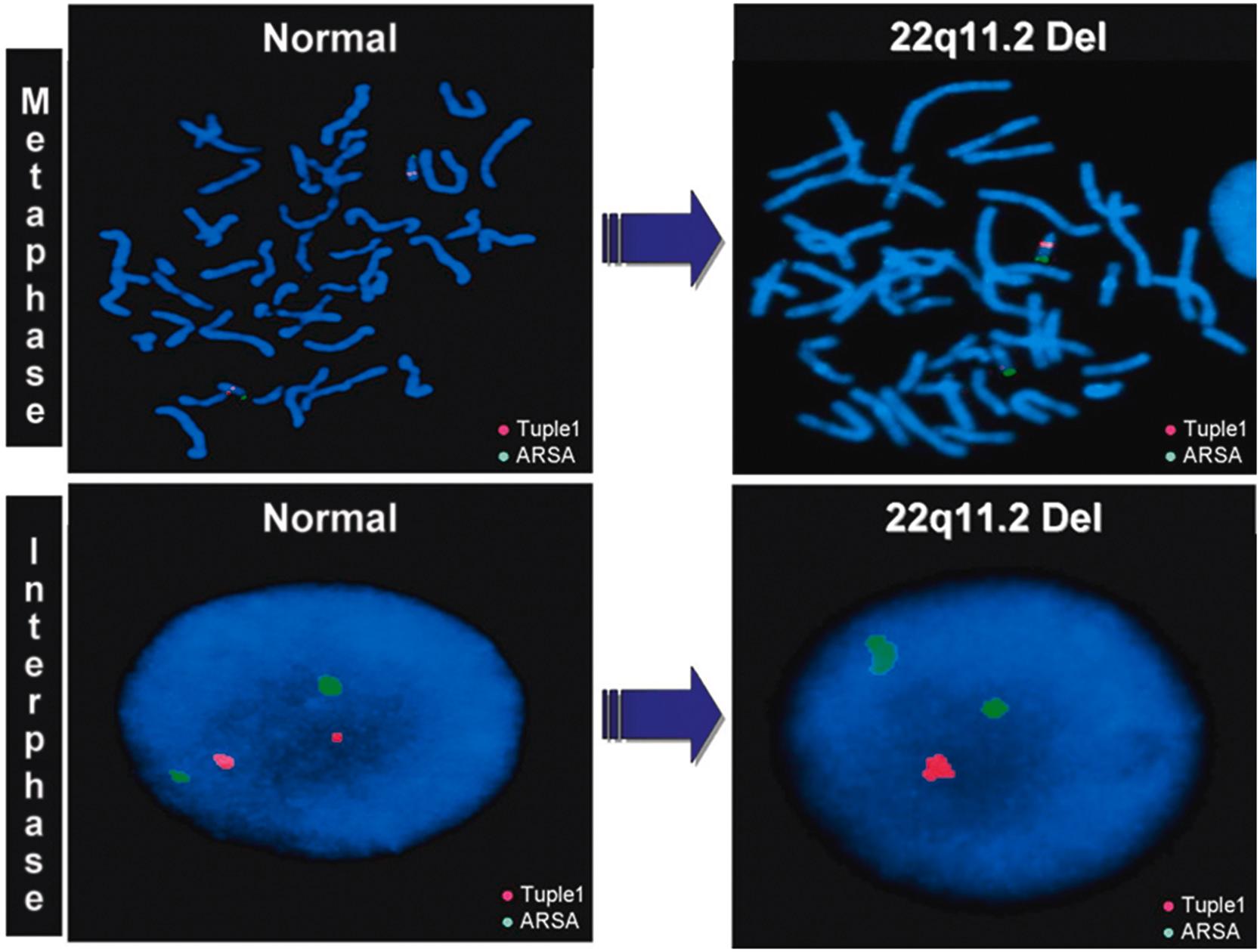 Figure 4.5, Fluorescent in situ hybridization demonstrating deletion of the 22q11 locus associated with Di George and velocardiofacial syndromes. The green probe marks chromosome 22 (a control) and the red fluorescence indicates the probe associated with the region of interest. The normal chromosomal spread is on the left and the abnormal on the right. Metaphase is shown at the top, with well-defined chromosomes, while interphase, with dispersed chromatin, is shown at the bottom.