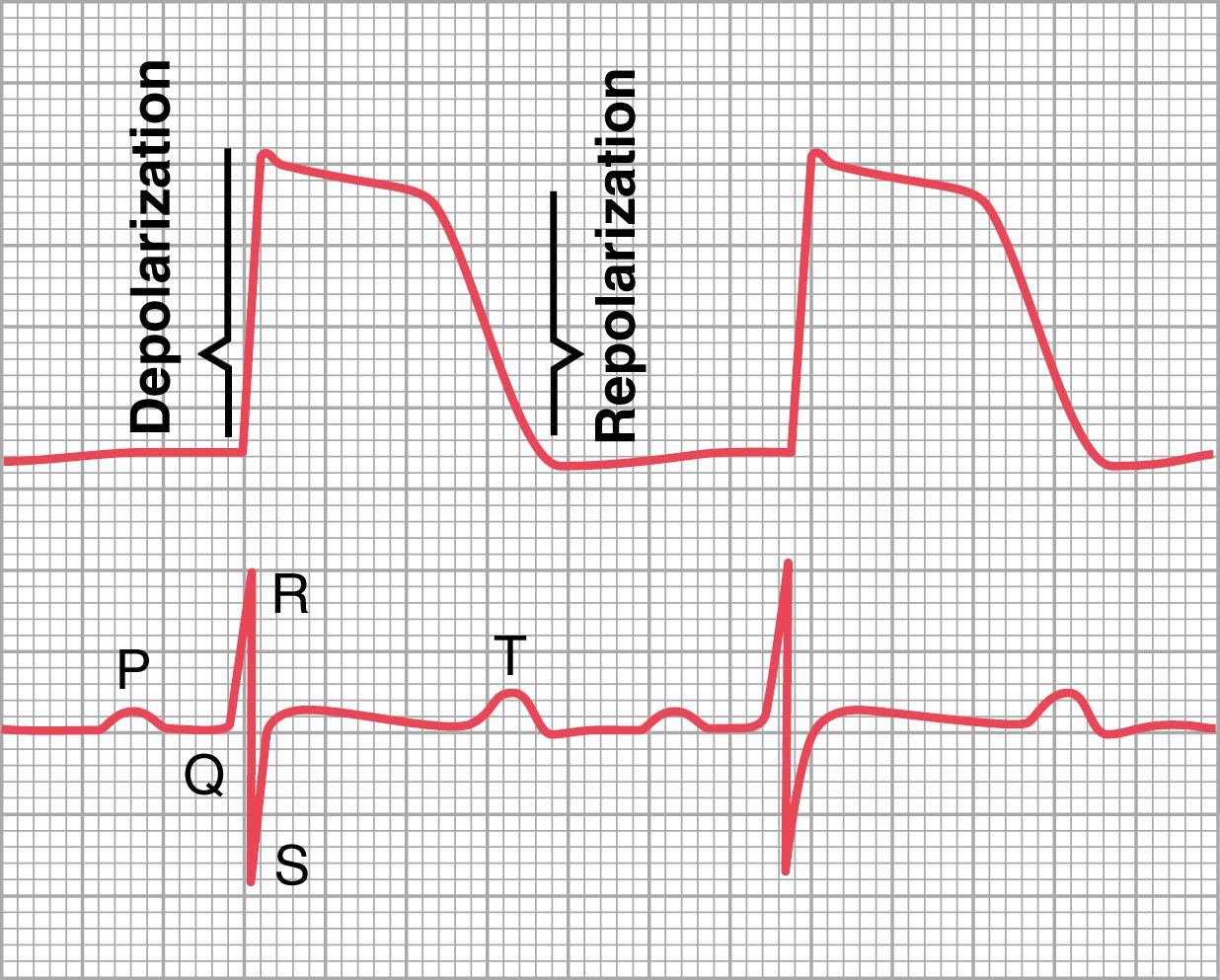 Figure 11-3., Top, Monophasic action potential from a ventricular muscle fiber during normal cardiac function showing rapid depolarization and then repolarization occurring slowly during the plateau stage but rapidly toward the end. Bottom, Electrocardiogram recorded simultaneously.