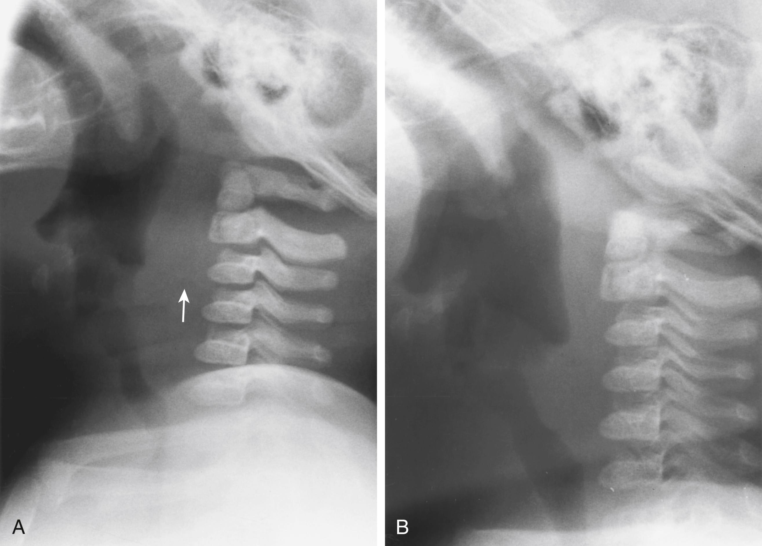 Fig. 25.9, Effect of phase of respiration on the prevertebral soft tissue space. Arrow in (A) demonstrates the prevertebral soft tissue widening on expiration that disappears on inspiration (B).