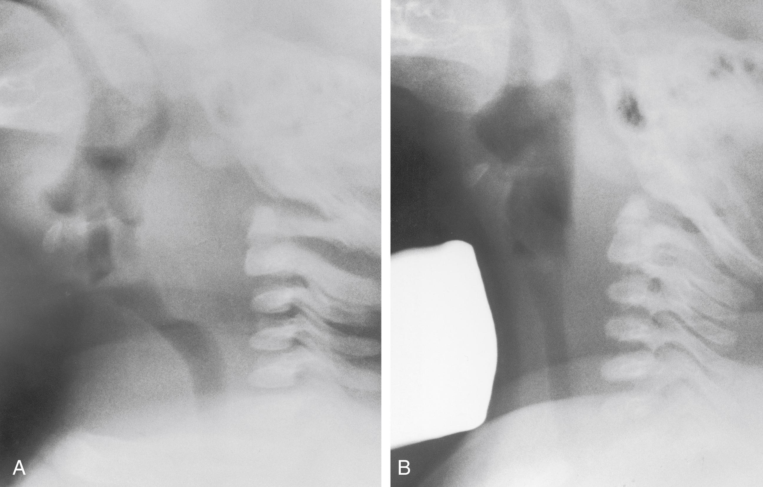 Fig. 25.10, False-positive identification of a retropharyngeal mass. (A) An examination with poor head extension suggests a retropharyngeal mass. (B) A repeat examination with better head extension and pressure applied to the anterior neck with a lead-gloved finger; the retropharyngeal soft tissues are normal. Intervention with a gloved finger is seldom necessary if the film is repeated in full extension and inspiration.