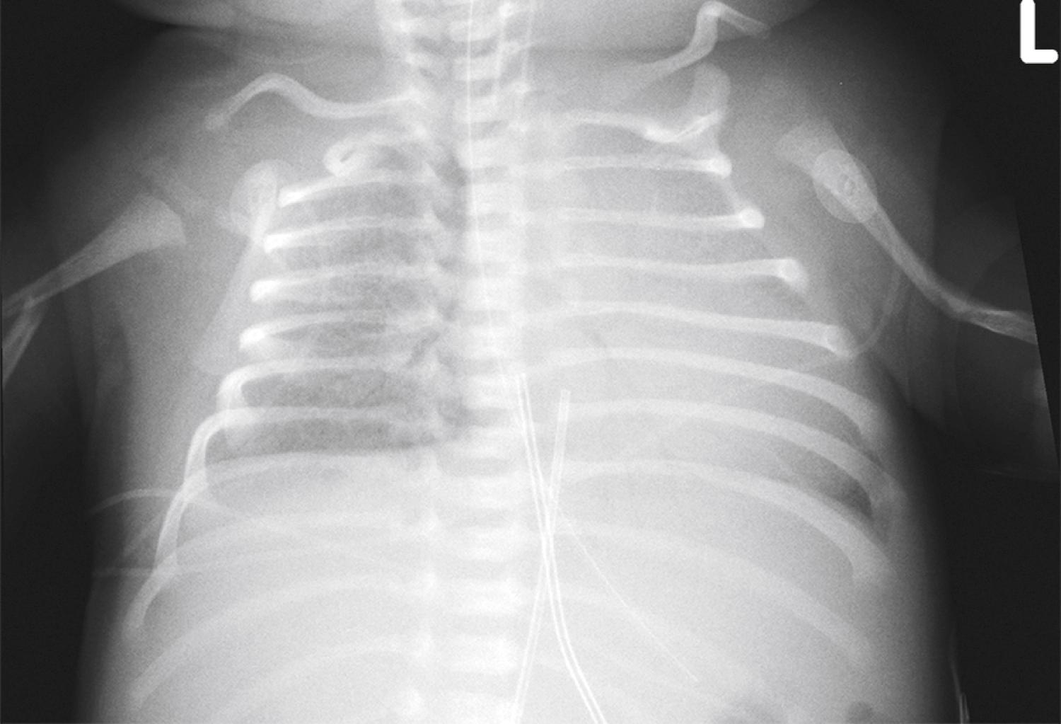 Fig. 25.11, Supine chest radiograph of a 3-day-old newborn with surfactant deficiency. A radiologist interpreting this chest film systematically, that is, by examining the ABCS (A, abdomen; B, bones; C, chest [airway, mediastinum, lungs, and diaphragm]; and S, soft tissues), should not miss the fracture involving the right humerus at the edge of the image. Note that the patient is rotated to the left with the heart appearing prominent, likely due to rotation.