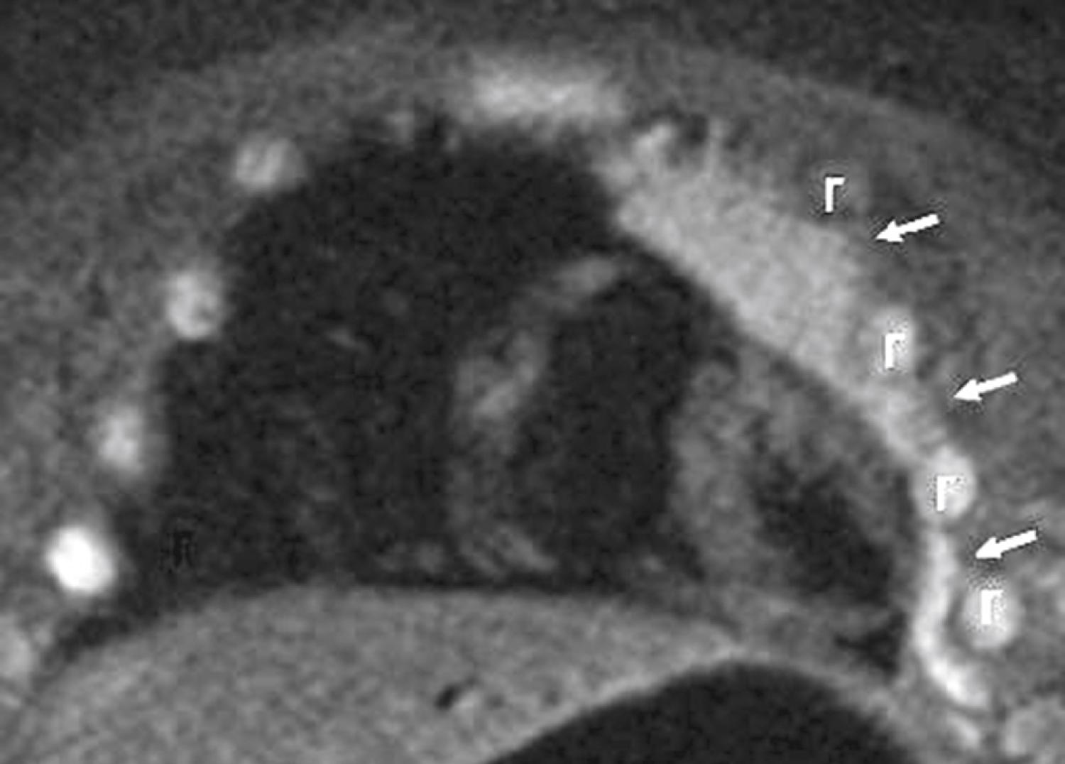 Fig. 25.12, Coronal magnetic resonance imaging (MRI) of the chest (short tau inversion recovery [STIR] sequence) demonstrates a left-sided normal thymus in a 7-month-old infant. An anterior cut shows the “wavy thymus sign” (arrows) as the thymus insinuates itself between the anterior ribs (r) .