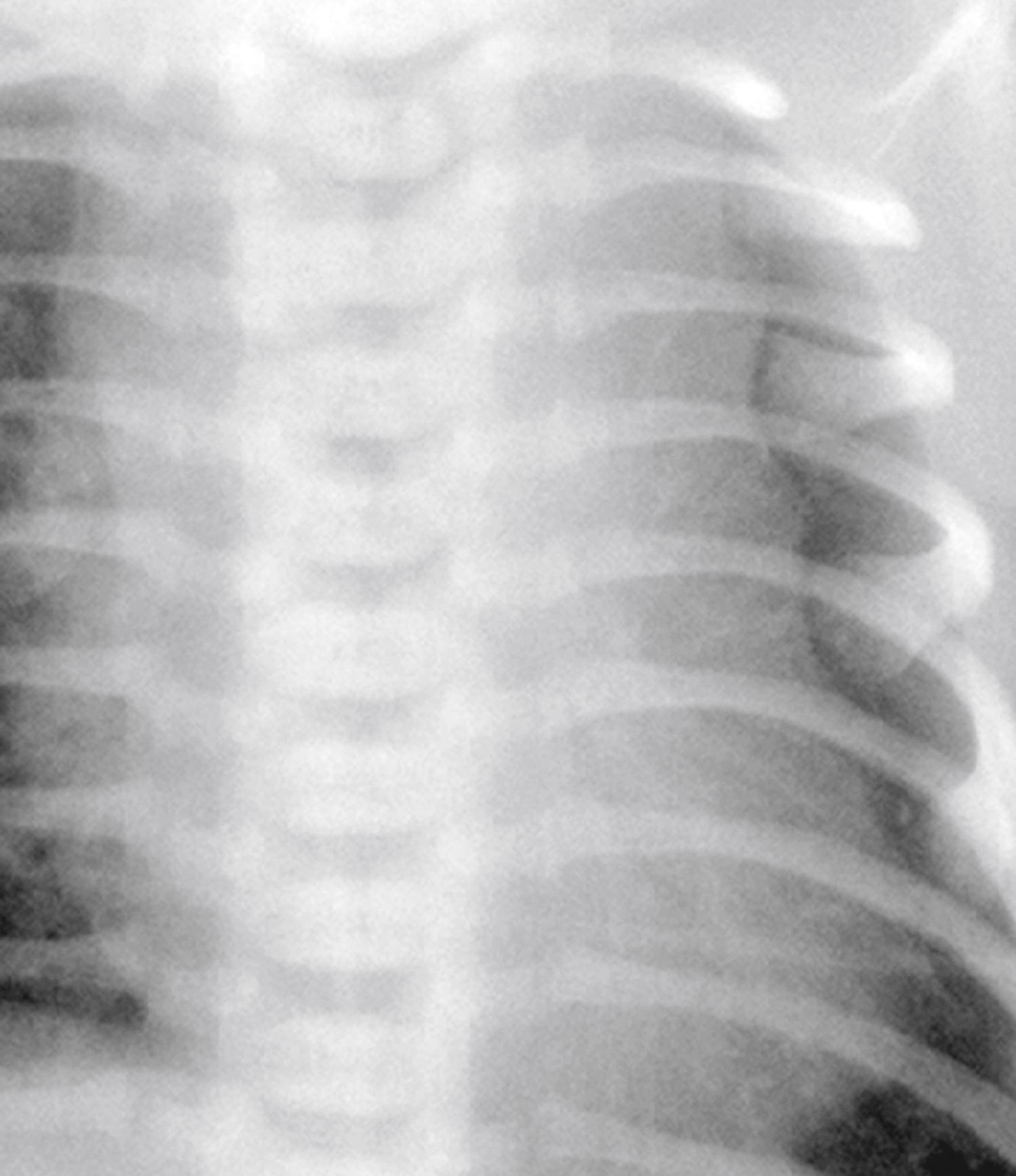 Fig. 25.13, Chest radiograph of a 1-day-old newborn shows the wavy thymus contour.