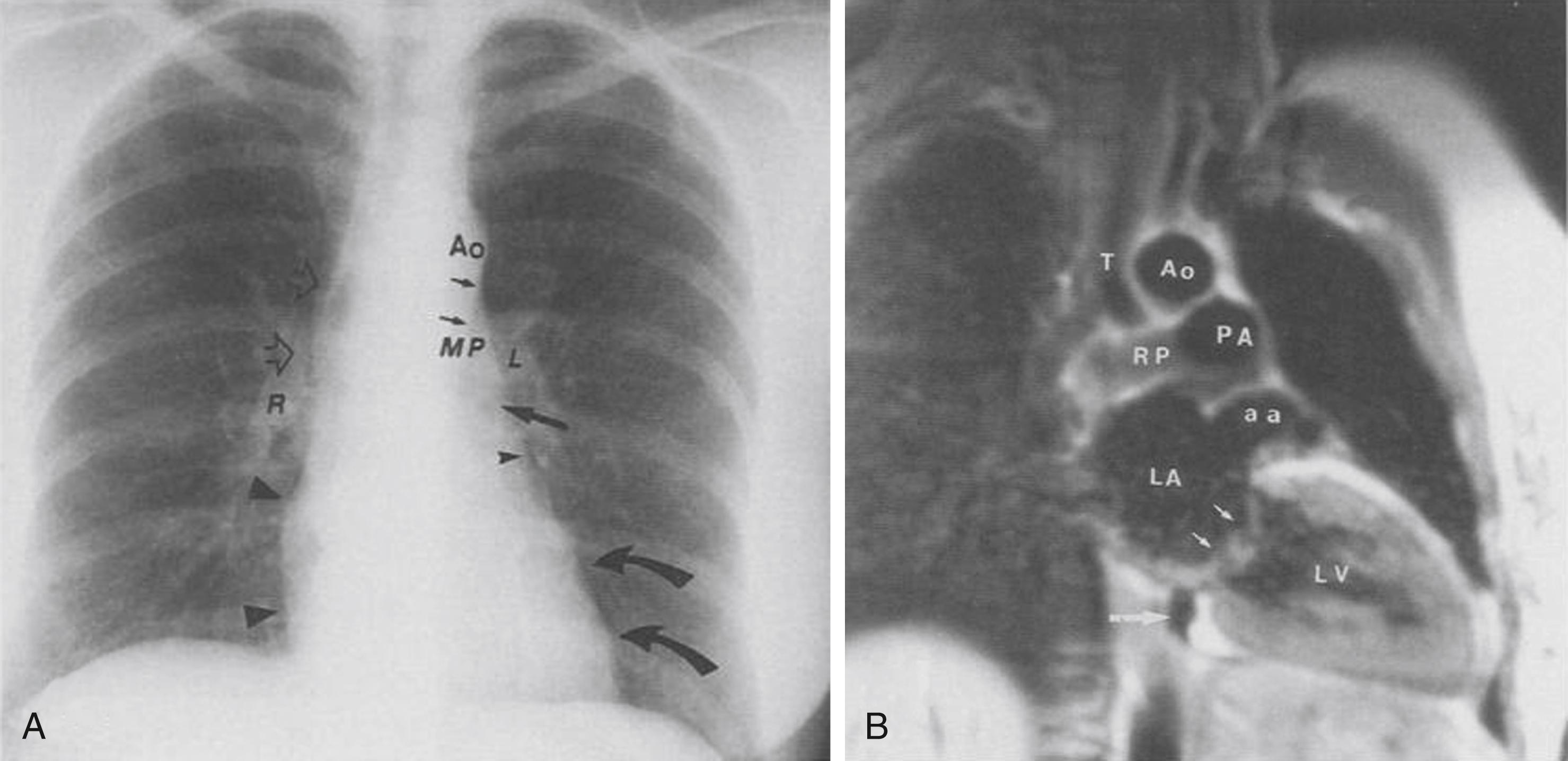 Fig. 25.14, (A) Posteroanterior radiograph of a 30-year-old woman is shown. The lateral border of the left-sided aortic arch (Ao) and proximal descending aorta (short arrows) are clearly seen. The main (MP) and proximal left (L) pulmonary artery are seen cephalad to the left bronchus (long arrow) . The left atrial appendage section (small arrowhead) is inferior to the crossing of the left bronchus and cephalad to the left ventricular contour (curved arrows) of the left heart border. The superior vena cava is not seen on this examination. However, the ascending aorta (small open arrow) is seen barely over the hilar right pulmonary artery (R) . The right atrial contour (large arrowheads) extends just to the right of the spine. (B) Spin-echo magnetic resonance imaging (MRI) obtained from a different 30-year-old woman is shown. The left heart border–forming structures are the aortic arch (Ao) , which is to the left of the trachea (T) , the distal main pulmonary artery (PA) , left atrial appendage (aa) , and anterolateral portion of the left ventricle (LV) . The transverse right pulmonary (RP) artery passes over the left atrium (LA) . Notice that the Ao and PA are equal in caliber. The mitral valve (small arrows) and coronary sinus (large arrow) are shown.