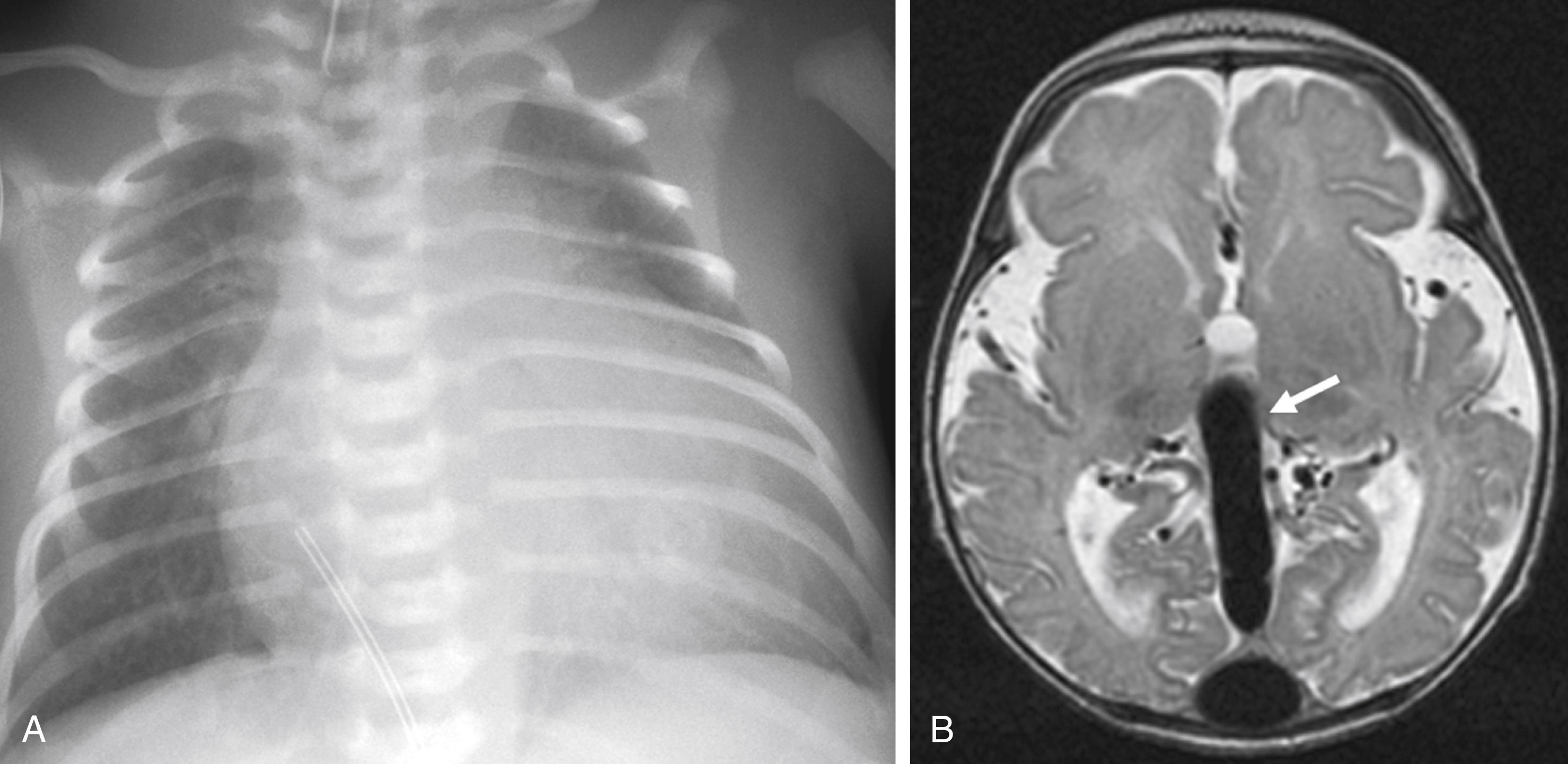 eFig. 25.3, (A) Congestive heart failure in a 5-day-old infant. (B) Axial T2 fast spin-echo magnetic resonance imaging (MRI) shows vein of Galen malformation (arrow) .