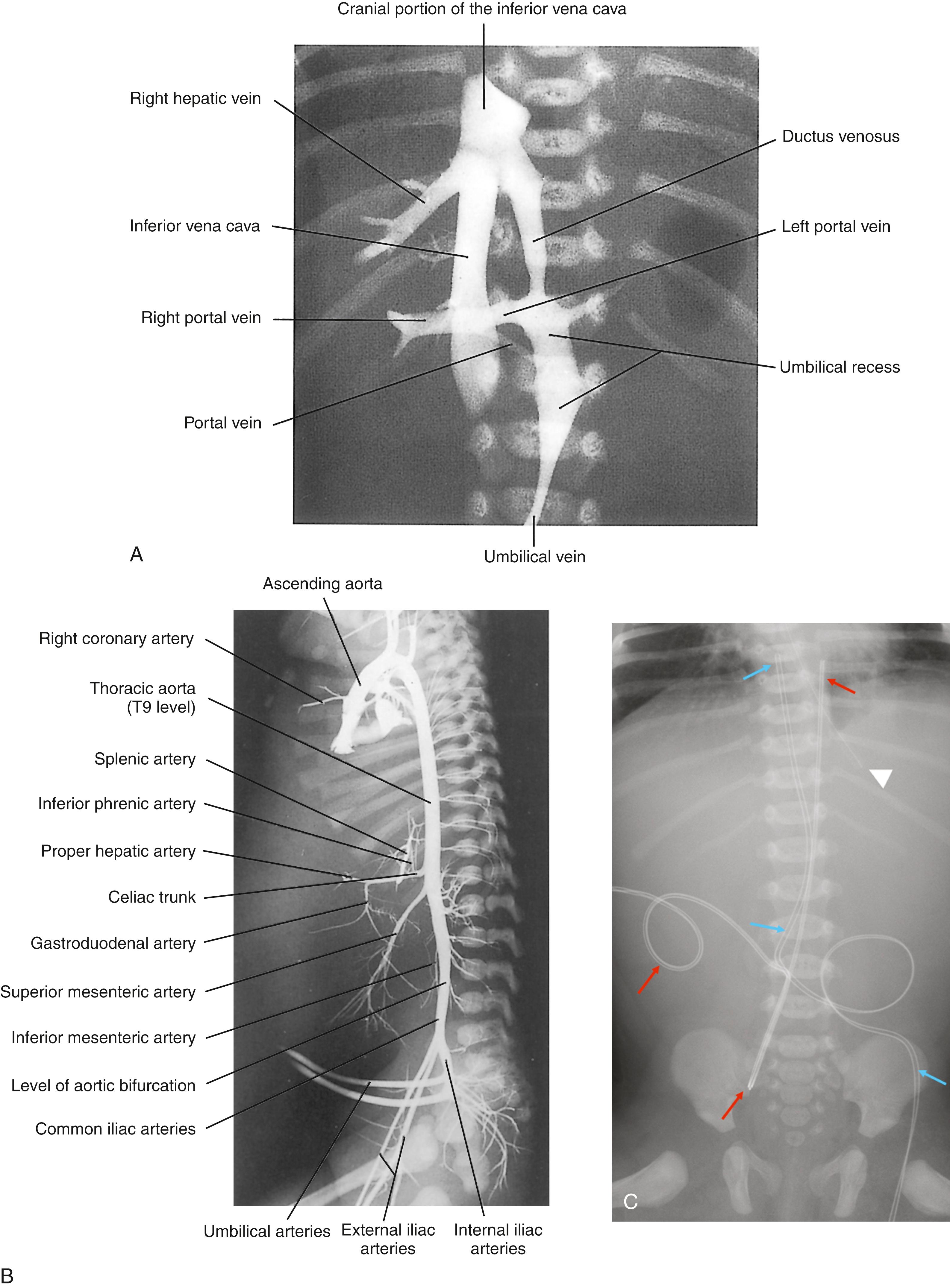 Fig. 25.15, (A) Postmortem demonstration of the umbilical recess with its junction to the ductus venosus and the left portal vein. Twin premature, 27 weeks of gestation, deceased on the first day of life. (B) Male term newborn. Postmortem normal angiography. The angle between the umbilical arteries and the internal iliac arteries may make catheterization via the umbilical artery more difficult. (C) Supine radiograph of the abdomen of a 3-day-old newborn shows the umbilical venous line (blue arrow) with the tip in the right atrium, and the umbilical arterial line (red arrow) with the tip in the aorta at T8. Ar, Nasogastric tube.