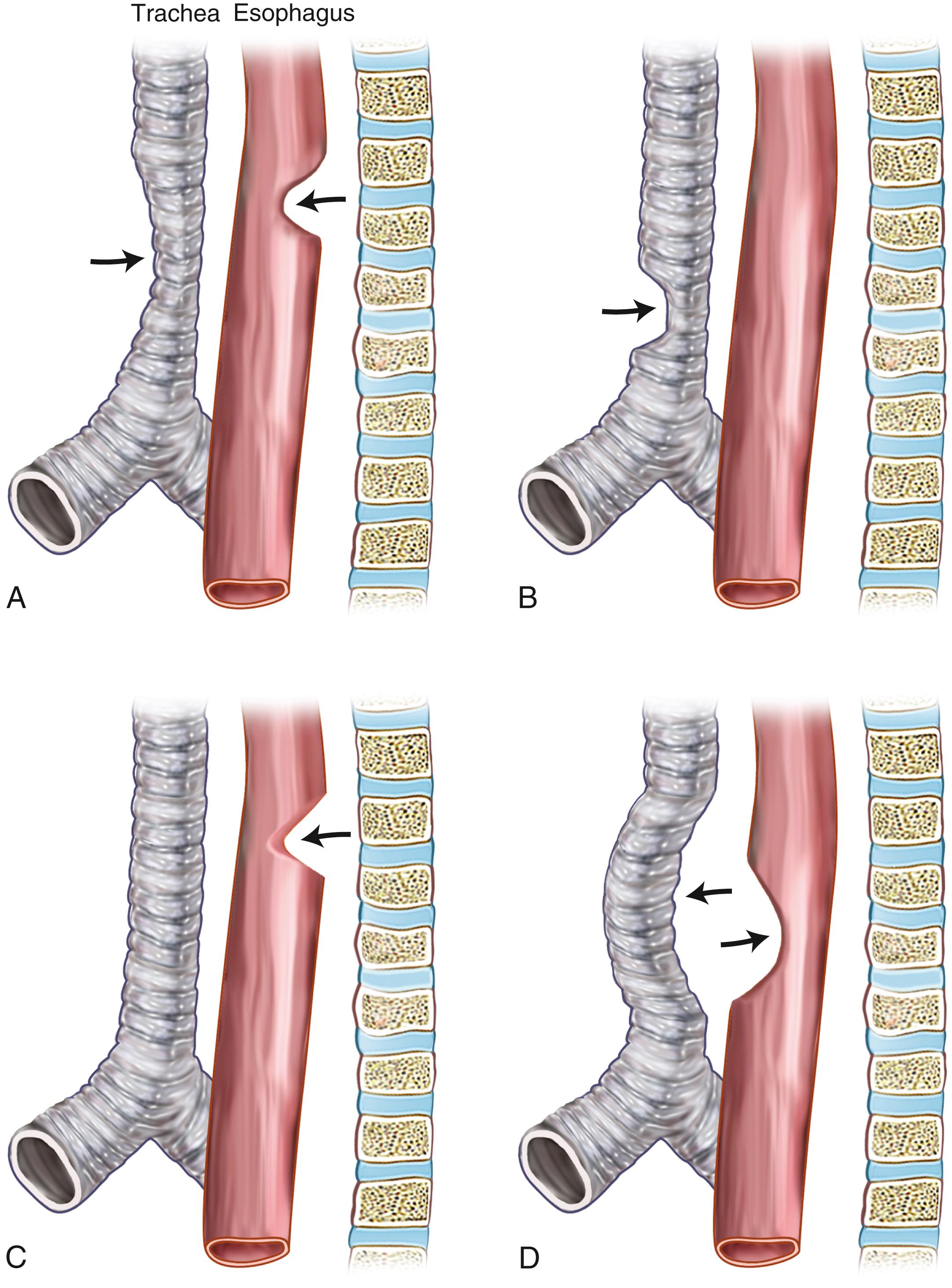 Fig. 25.16, Four patterns of vascular compression anomalies on the trachea and esophagus. Lateral projections are shown. (A) Double aortic arch or right aortic arch with aberrant left subclavian artery. (B) Innominate artery compression. (C) Left aortic arch with aberrant right subclavian artery. (D) Pulmonary sling.