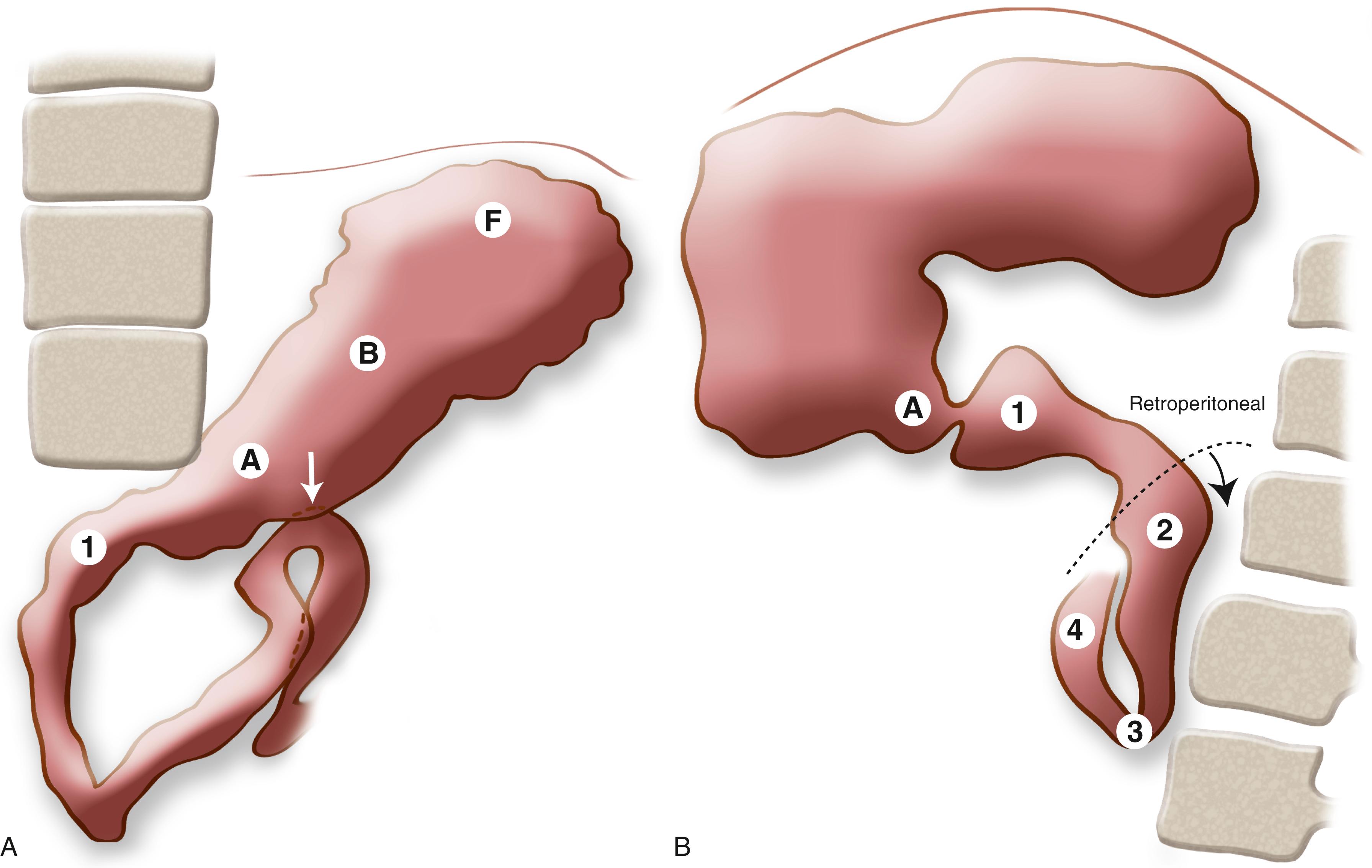 Fig. 25.17, Upper gastrointestinal (UGI) study demonstrating normal duodenal course in a 3-year-old. (A) Anteroposterior projection: The duodenojejunal junction (DJJ; arrow ) is at the level of the duodenal bulb and to the left of the left spinal pedicle. 1, Duodenal bulb; A, antrum; B, body; F, fundus. (B) Lateral projection: Note the four portions of the duodenum (1, 2, 3, 4) . The second, third, and fourth portions of the duodenum are posterior, within the retroperitoneum. Slight obliquity allows visualization of both the descending (2) and ascending (4) duodenum. A, Antrum.