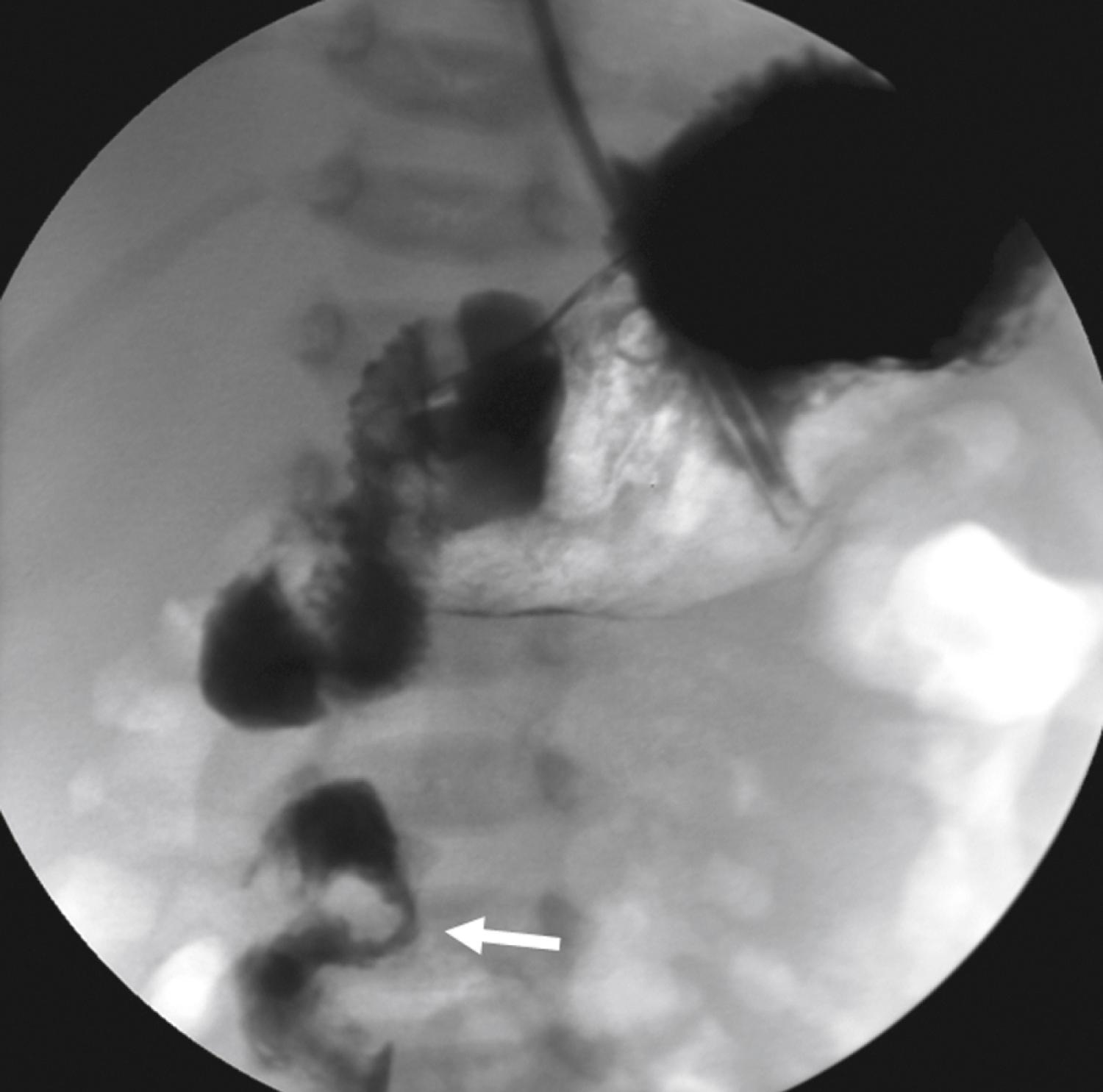 Fig. 25.18, Upper gastrointestinal (UGI) study in a 6-day-old showing malrotation with midgut volvulus. The duodenal sweep fails to cross the midline and assumes a corkscrew appearance (arrow) projecting on the right side of the spine.