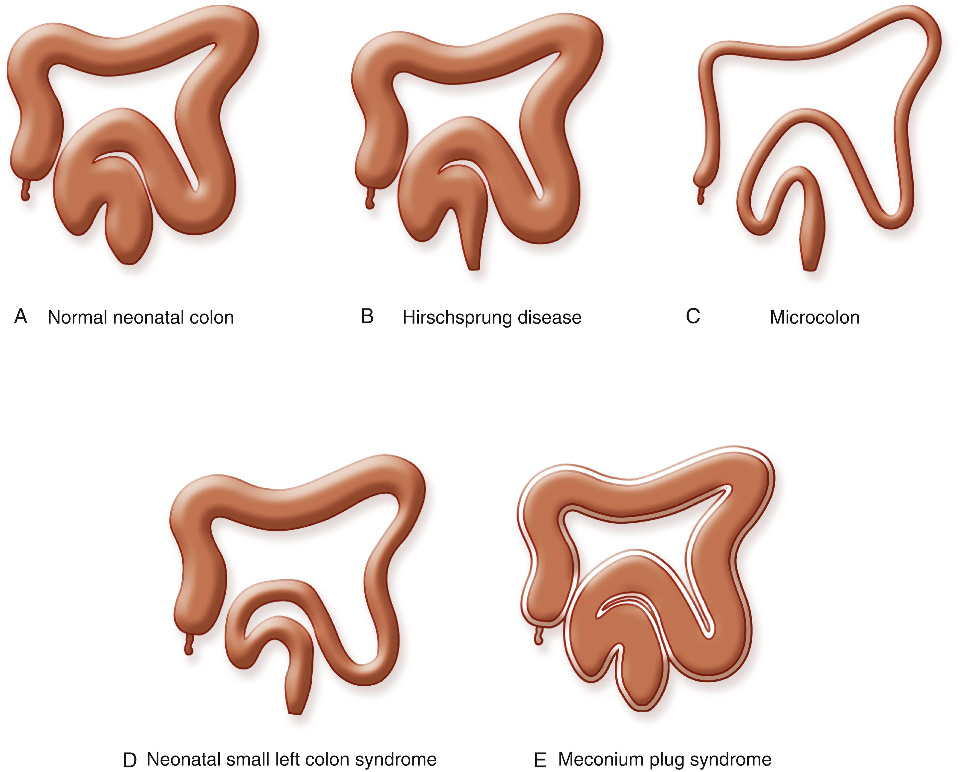 Fig. 25.19, (A) to (E) Schematic representation of mechanical and functional obstruction in the neonatal period.