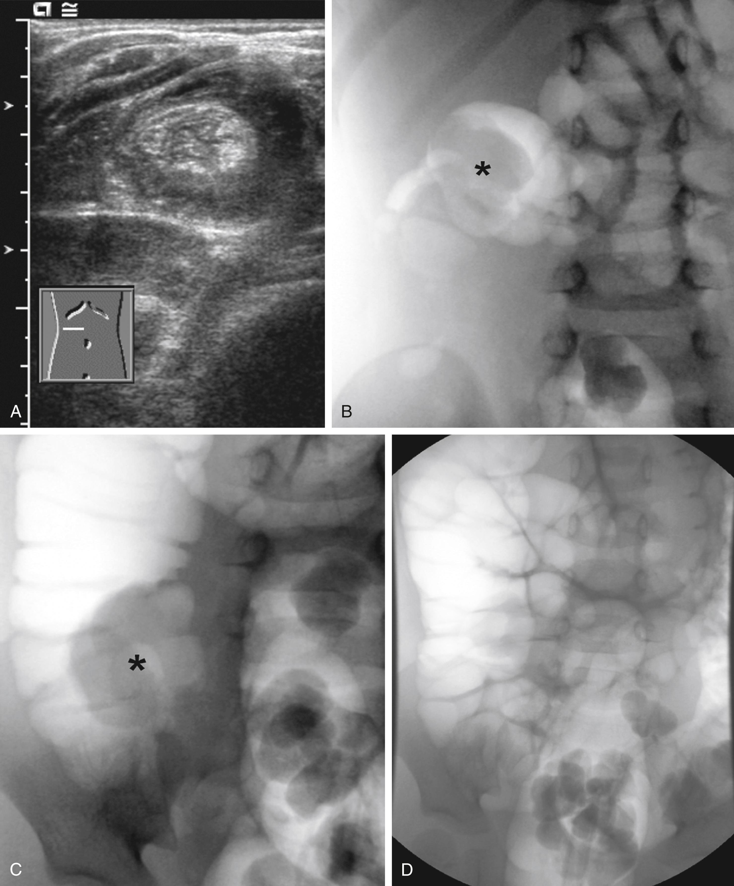 Fig. 25.20, Ileocolic intussusception in the proximal transverse colon of a 2-year-old. (A) Ultrasound shows the characteristic “target sign” on transverse section (hypoechoic ring with an echogenic center). (B) to (D) Air enema reduction. (B) Intussusception (asterisk) is initially located in the right upper quadrant; (C) Intussusception (asterisk) has moved retrograde and is now in the region of the ileocecal valve; (D) Successful reduction with resolution of the soft tissue mass and reflux of air into the terminal ileum.