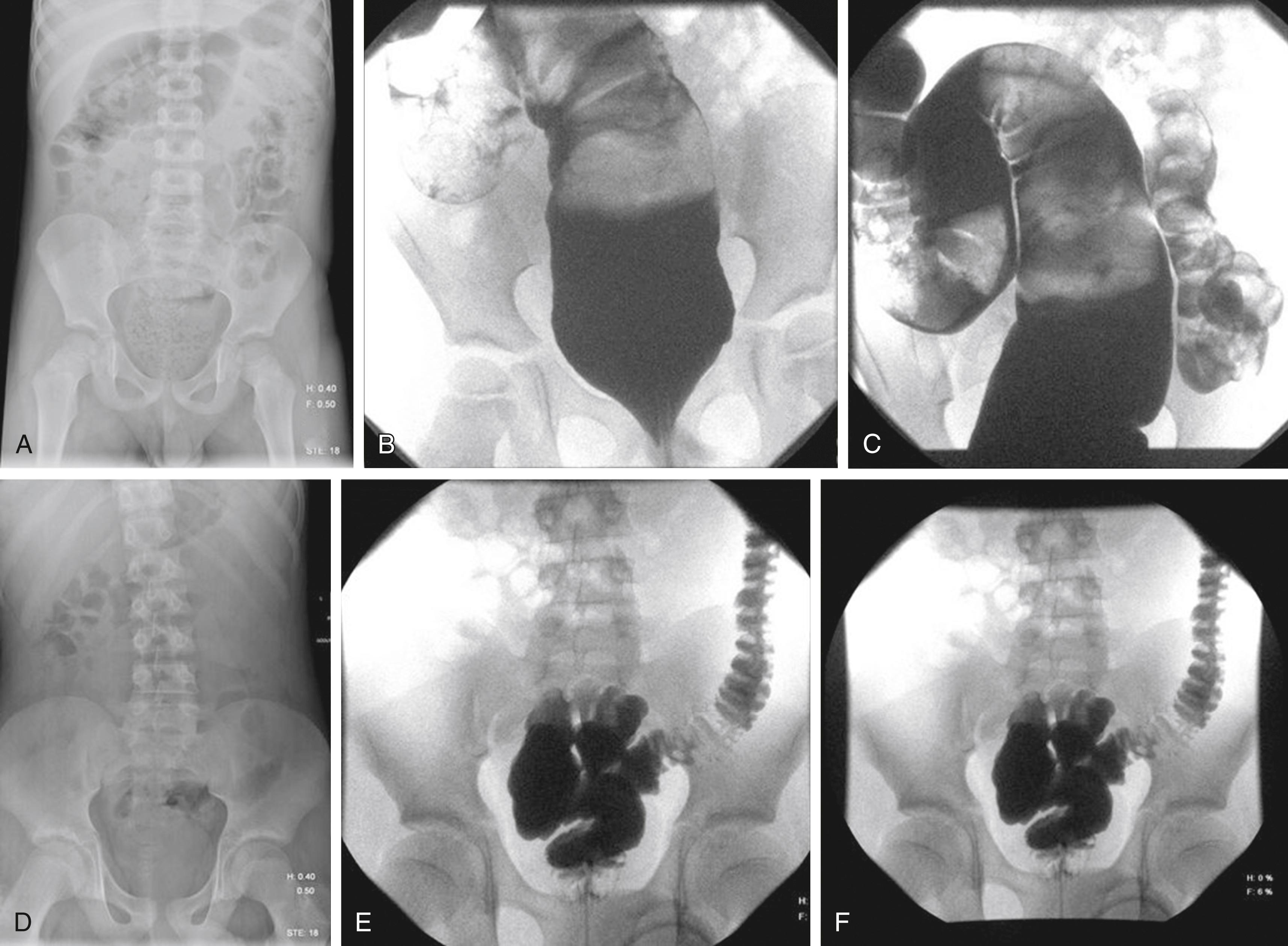 Fig. 25.21, (A) Abdominal radiograph shows stool distended in rectum. (B) and (C) Contrast enema shows the rectum distended in pseudofecal incontinence. (D) Abdominal radiograph in true fecal incontinence shows the rectum is empty and not much stool in the colon. (E) and (F) Radiographs show the rectum not dilated and increased haustration in the colon.