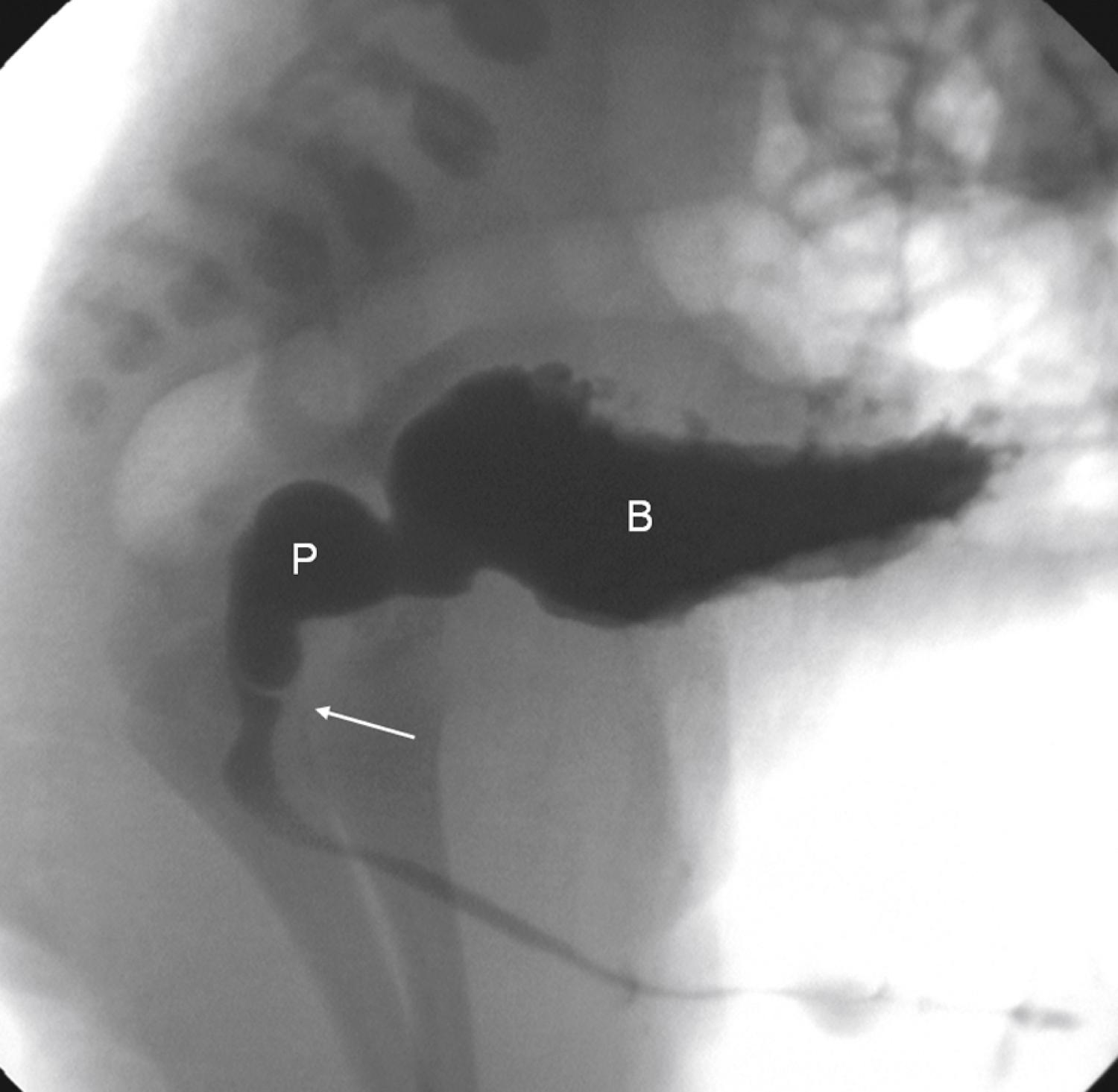 Fig. 25.23, Voiding cystourethrogram (VCUG) in a 1-day-old boy. Lateral view during voiding after catheter removal demonstrates the posterior urethral valve as a lucent line (arrow) separating the dilated posterior urethra (P) from the distal urethra. Note the trabeculated thick-walled bladder (B) .