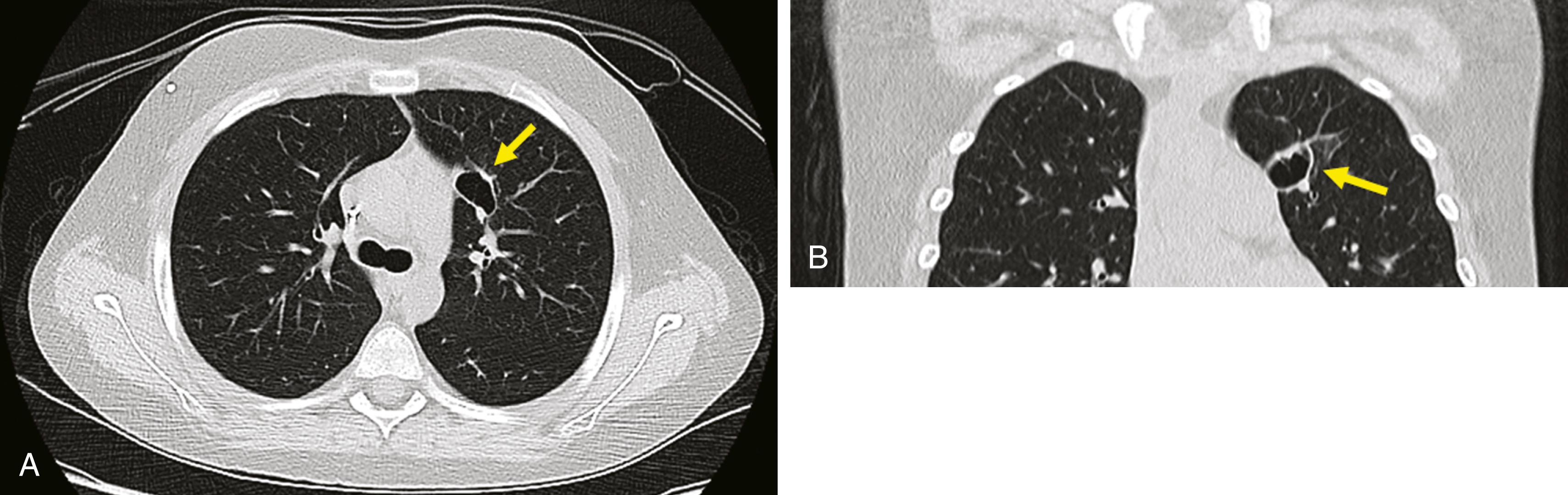 Fig. 25.5, Targeted low-dose computed tomography (CT) of the upper chest of a 12-year-old for follow-up of left upper lobe cavity (arrow) ; effective dose, 0.5 mSv. (A) Axial image. (B) Coronal reformatted image.