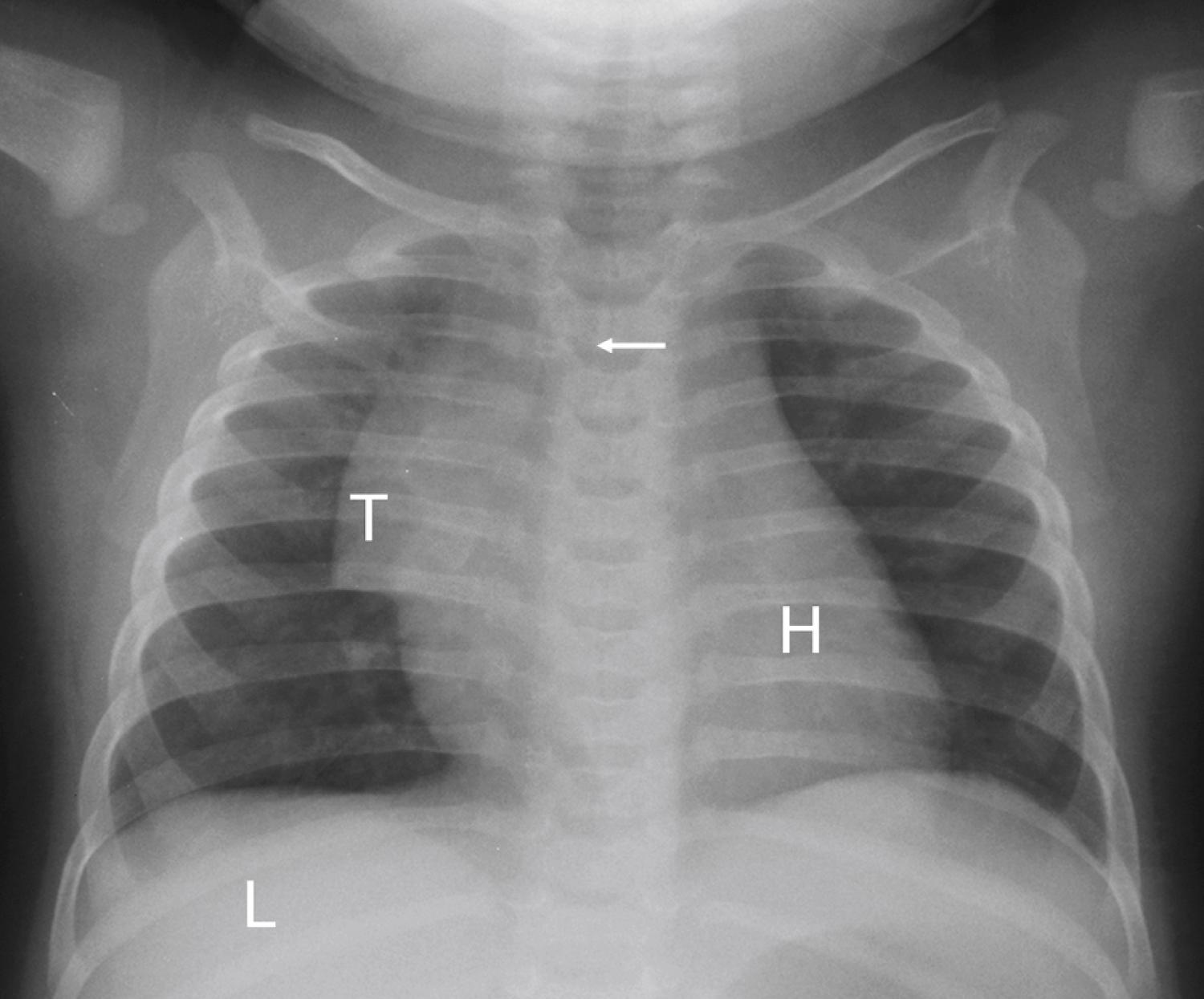 eFig. 25.2, An x-ray image. Shown is an anteroposterior chest radiograph of an infant, demonstrating the attenuation of the various body structures. The normal lungs are air-filled and therefore black. The heart (H) and liver (L) have absorbed some radiation and are slightly gray. The bones are dense, and are a lighter shade of gray to white. Note the sail sign of the normal thymus (T) and the rightward deviation of the distal trachea (arrow) by the normal left-sided aortic arch.