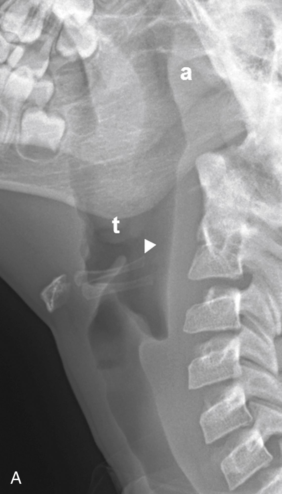 Fig. 25.7, (A) Lateral radiograph of a normal airway. The cornua of the hyoid (ar) point to the epiglottis. a, Adenoids; t, tonsil. (B) Diagrammatic representation of the normal anatomy of the upper airway.