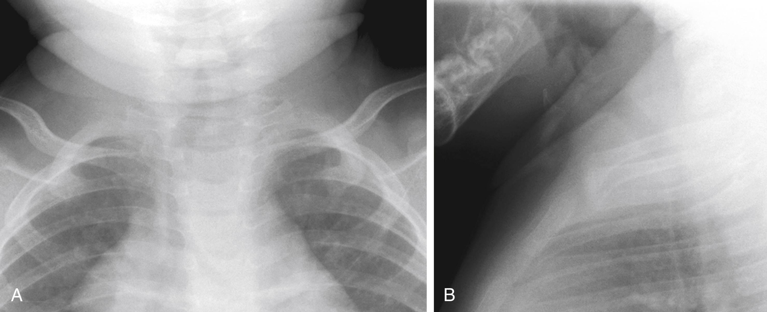 Fig. 25.8, Normal tracheal buckling. Chest radiographs of a 4-month-old infant demonstrate tracheal buckling, a normal occurrence when the film is exposed during flexion and/or expiration. (A) In the frontal projection, normal tracheal buckling occurs rightward, away from the aortic arch. (B) Anterior buckling is evident on the lateral projection. This normal anterior tracheal displacement frequently causes confusion because it simulates a retropharyngeal mass. Note that the airway should be visible on all normal chest films.