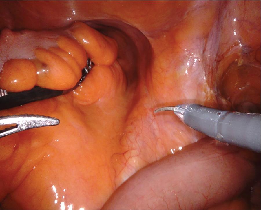 Fig. 4.1, Retraction of the Sigmoid With the Fourth Arm to Expose the Iliac Vessels.