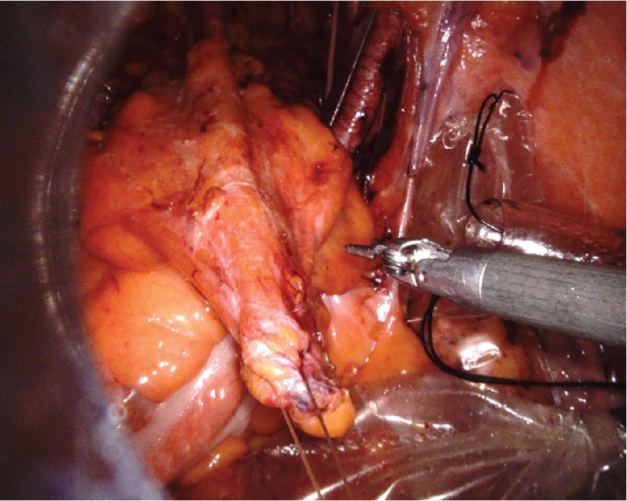 Fig. 4.2, Tissue Traction With a Traction Stitch.