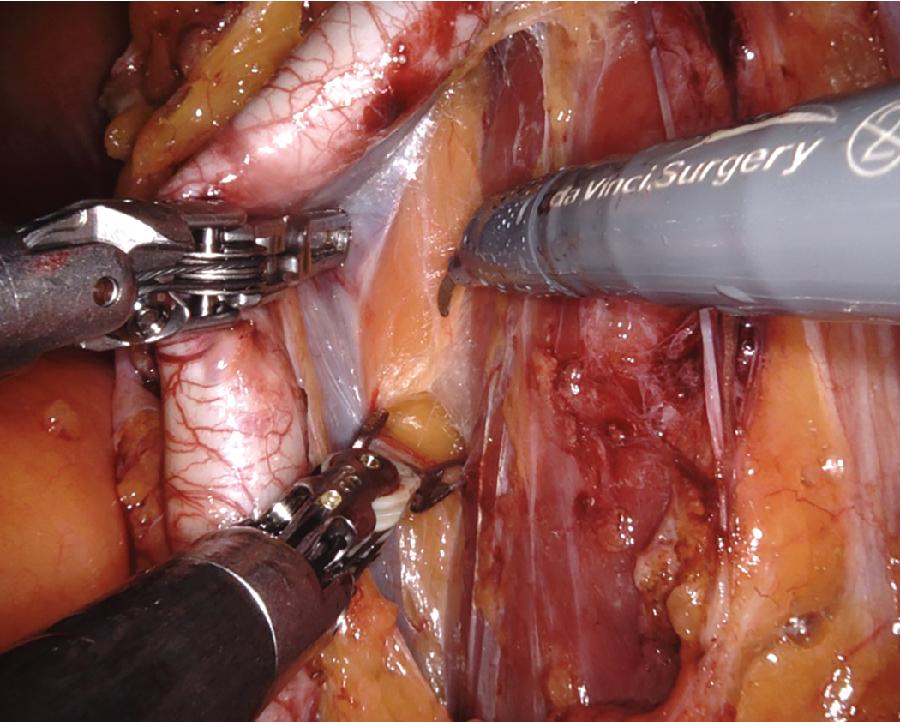 Fig. 4.3, Tissue Dissection With a Maryland Forceps After Tissue Retraction With the Fourth Arm.