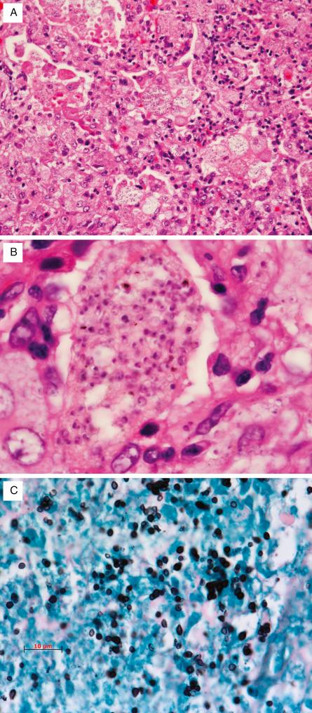 FIG. 12.1, Histoplasmosis. (A) Lung section from a patient with AIDS shows alveolar macrophages filled with Histoplasma capsulatum organisms. (B) Higher magnification shows the small 2- to 40-micron organisms. (C) Silver stain (GMS) shows small budding yeasts with buds connected by a narrow neck.