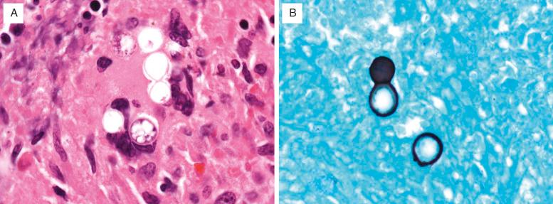 FIG. 12.2, Blastomycosis. (A) Thick, double-contoured hyaline wall of Blastomyces dermatitidis is seen in this surgical biopsy from a patient with acute progressive blastomycosis. Multiple nuclei can be seen. (B) Silver stain (GMS) demonstrates the 8- to 15-micron-in-diameter yeasts, multinucleated, with broad-based budding. The double contour of the wall is usually not apparent in silver stains.