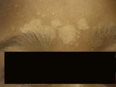 Figure 14.13, Tinea versicolor.