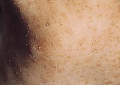 Figure 14.2, Congenital candidiasis. Diffusely distributed, distinct pustules.
